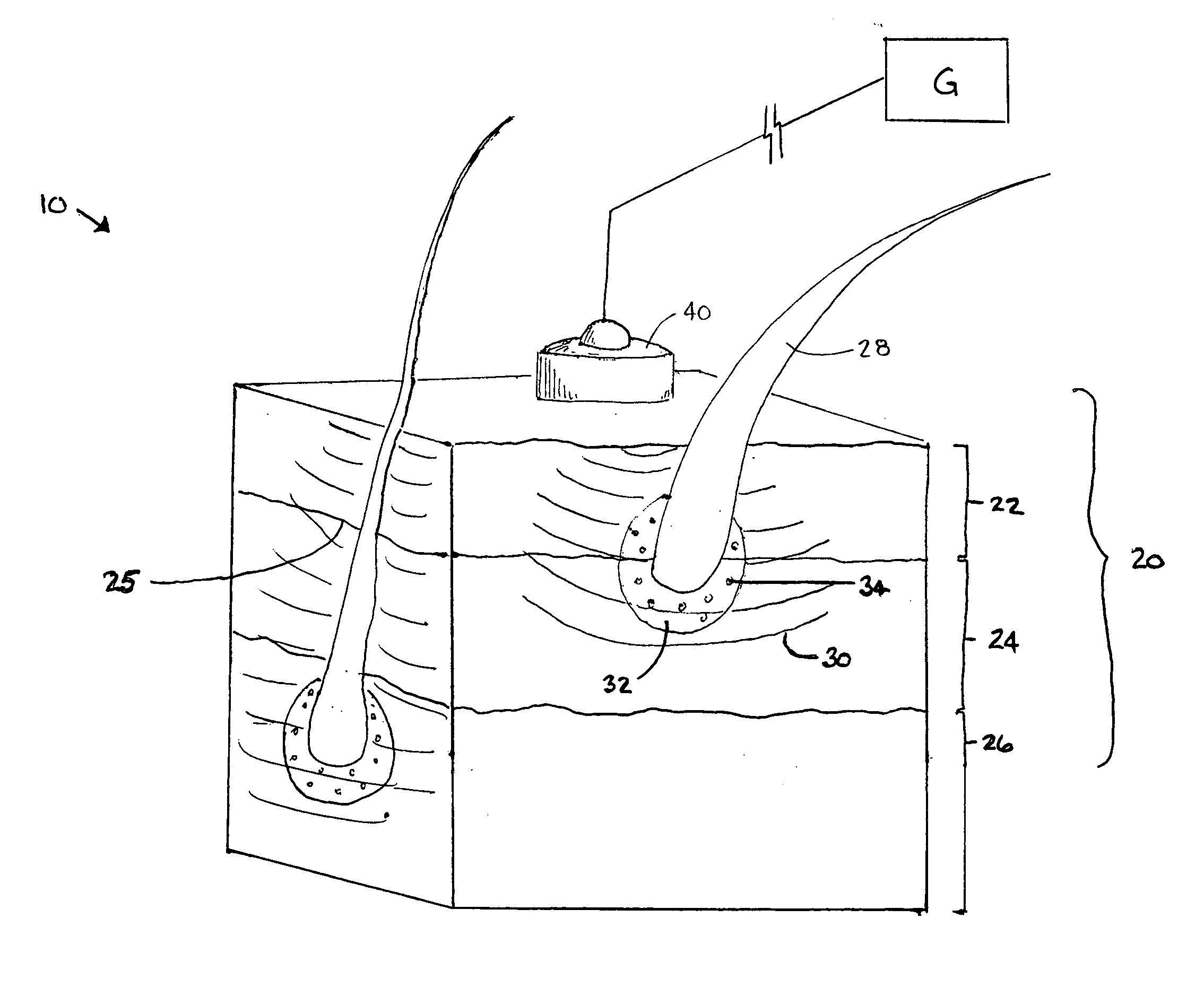 Ultrasound-based treatment methods for therapeutic treatment of skin and subcutaneous tissues