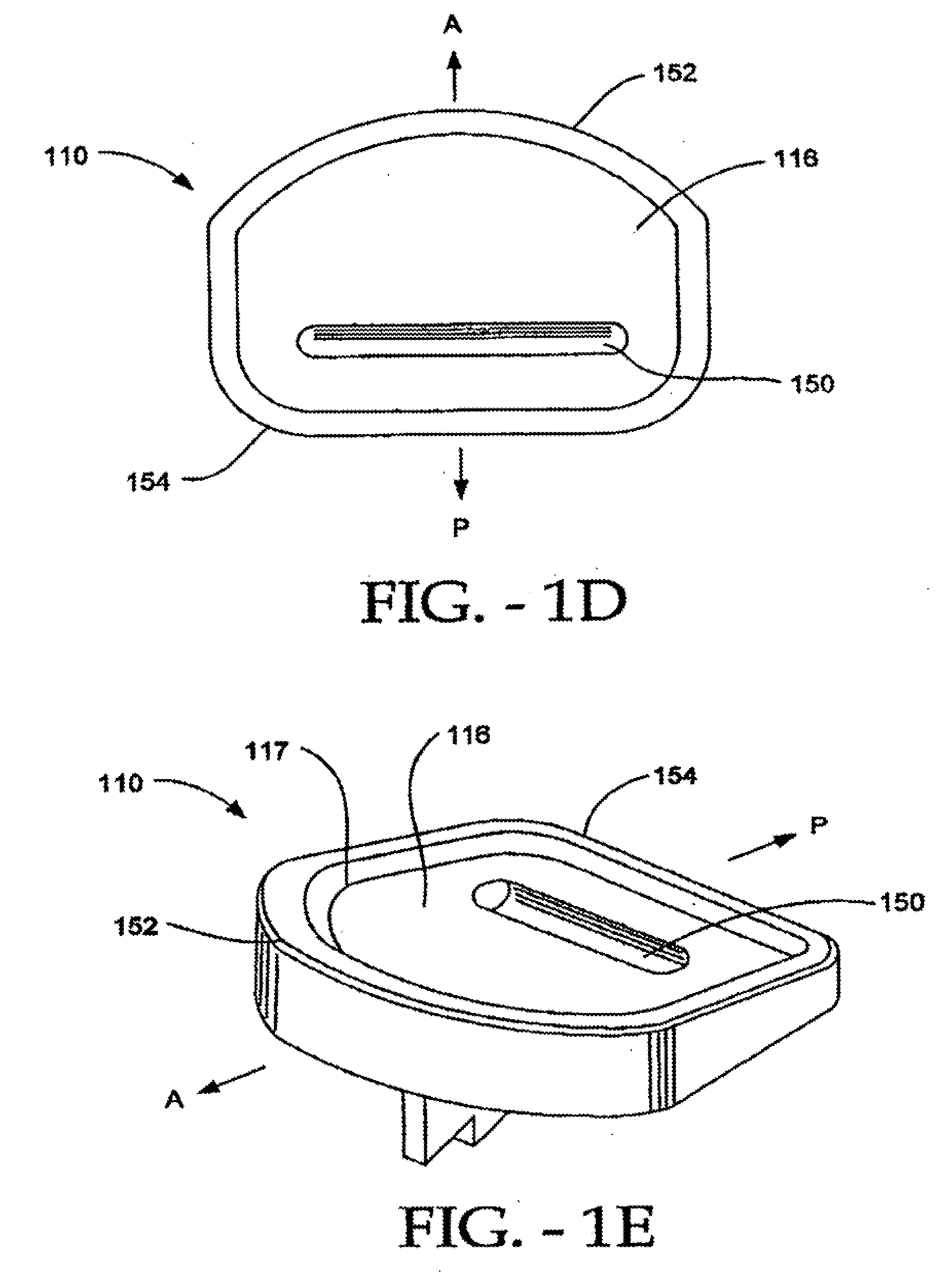 Artificial vertebral disk replacement implant with crossbar spacer and method