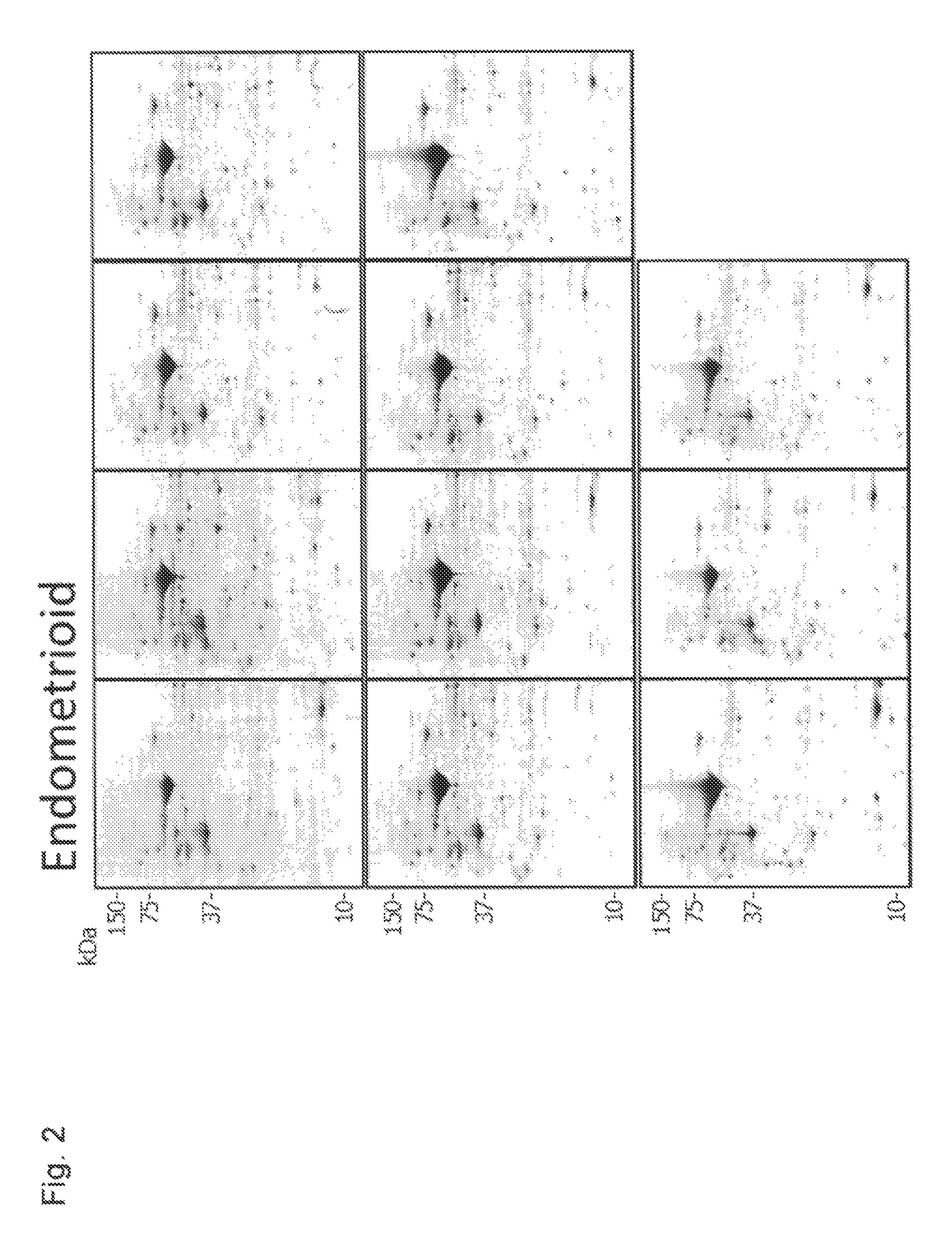 Marker for identification of tissue type of epithelial ovarian cancer, and method for determination of the occurrence of epithelial ovarian cancer based on tissue type by using the marker