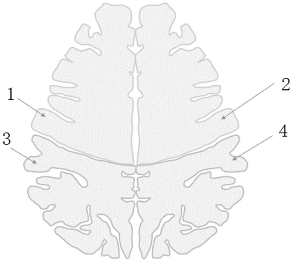 Automatic white matter lesion quantitative analysis system and interpretation method