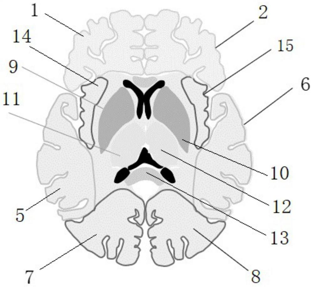 Automatic white matter lesion quantitative analysis system and interpretation method