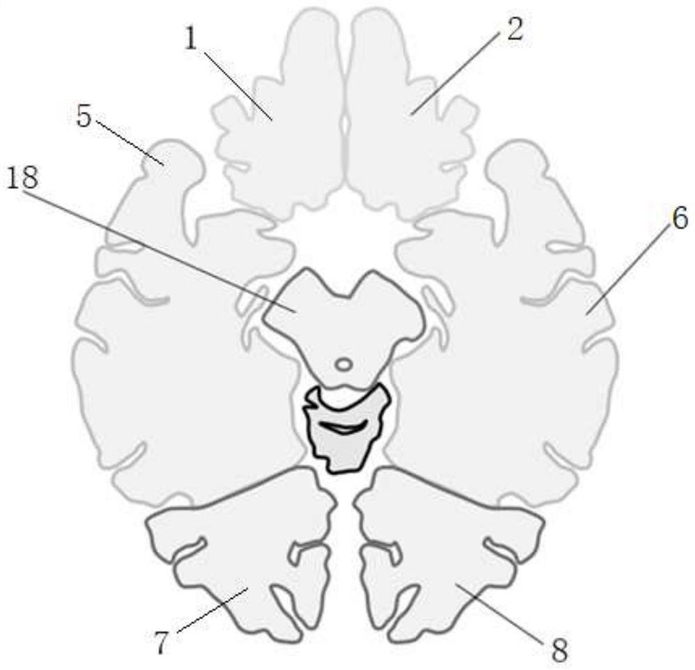 Automatic white matter lesion quantitative analysis system and interpretation method