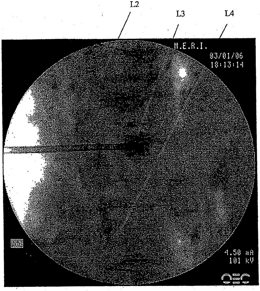 Compositions and methods for treating the vertebral column