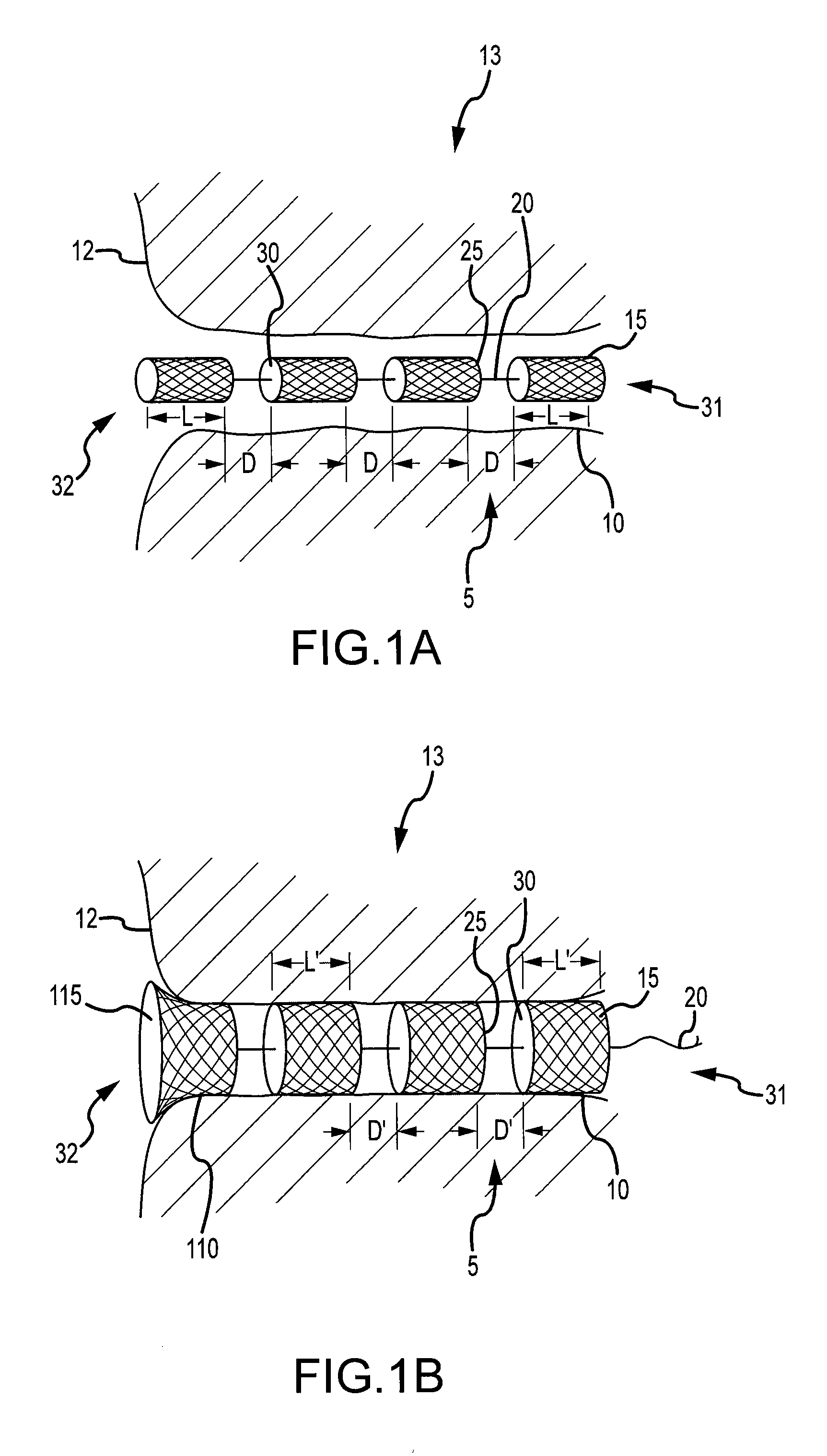 Implantable fistula closure device