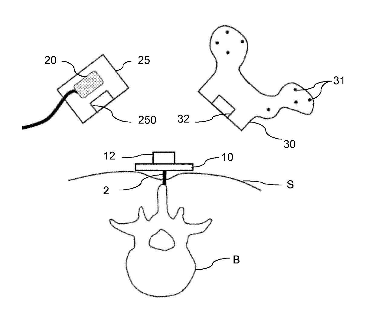 Device for minimally invasive attachment of a tracker and/or a registration phantom to a patient's bone