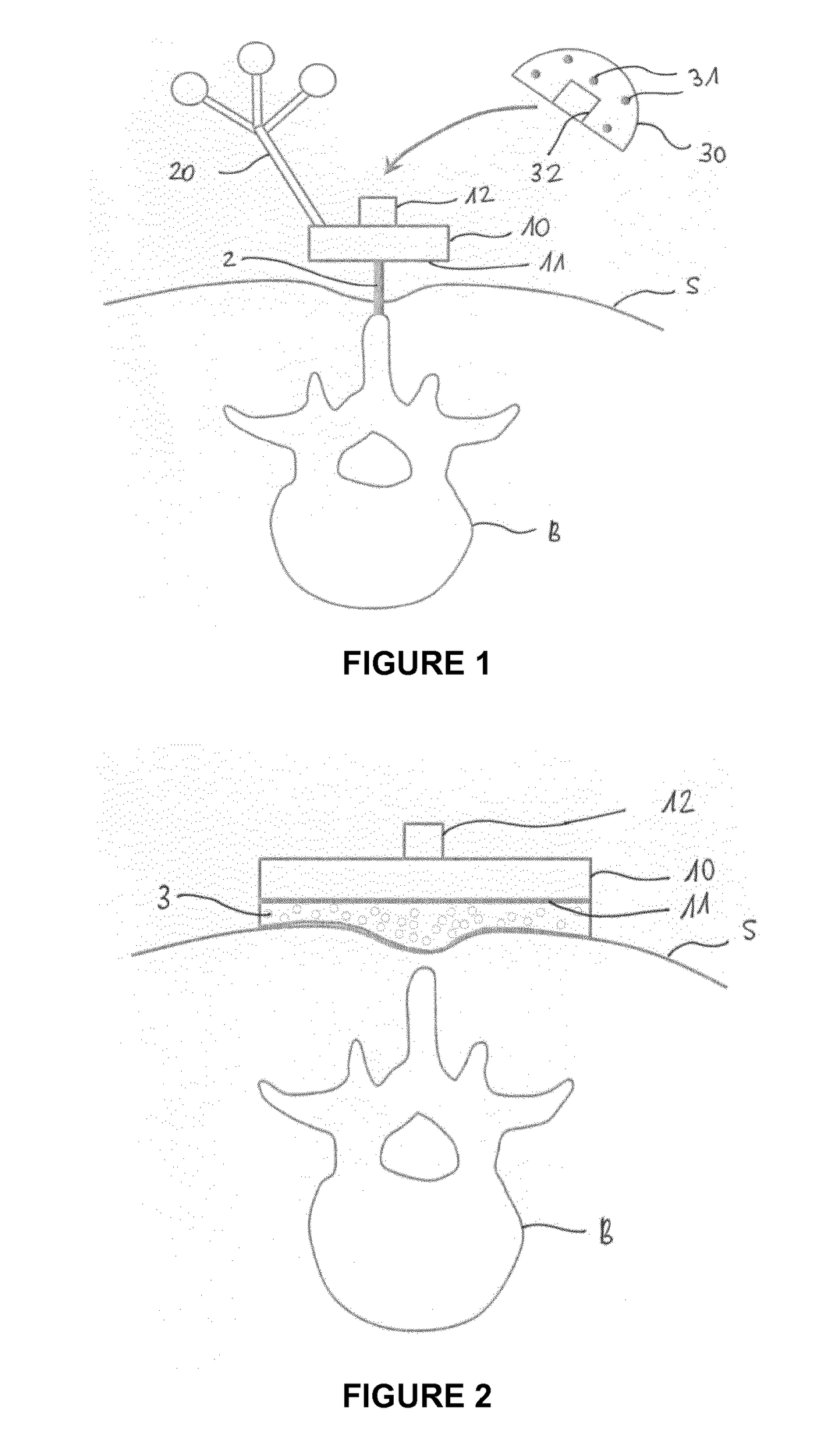 Device for minimally invasive attachment of a tracker and/or a registration phantom to a patient's bone