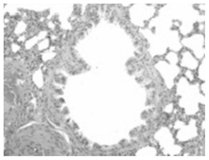 Urinary Protein Markers of Chronic Obstructive Pulmonary Disease and Its Application in Early Diagnosis