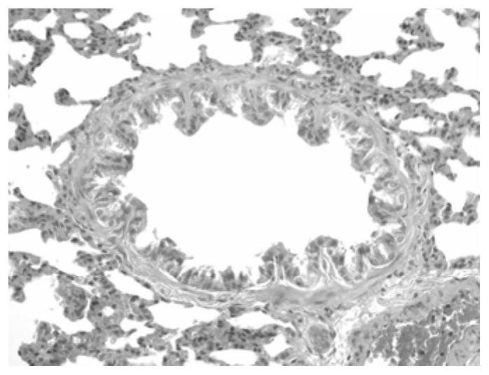 Urinary Protein Markers of Chronic Obstructive Pulmonary Disease and Its Application in Early Diagnosis