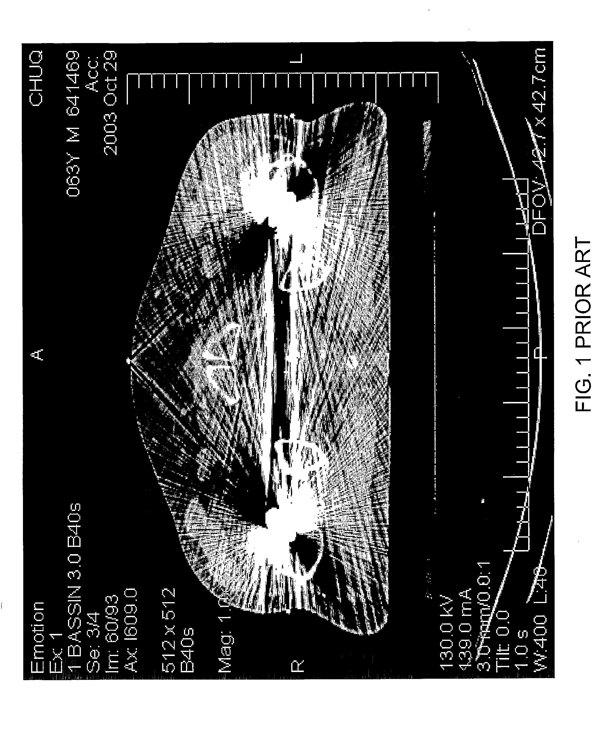 Method and apparatus for metal artifact reduction in computed tomography