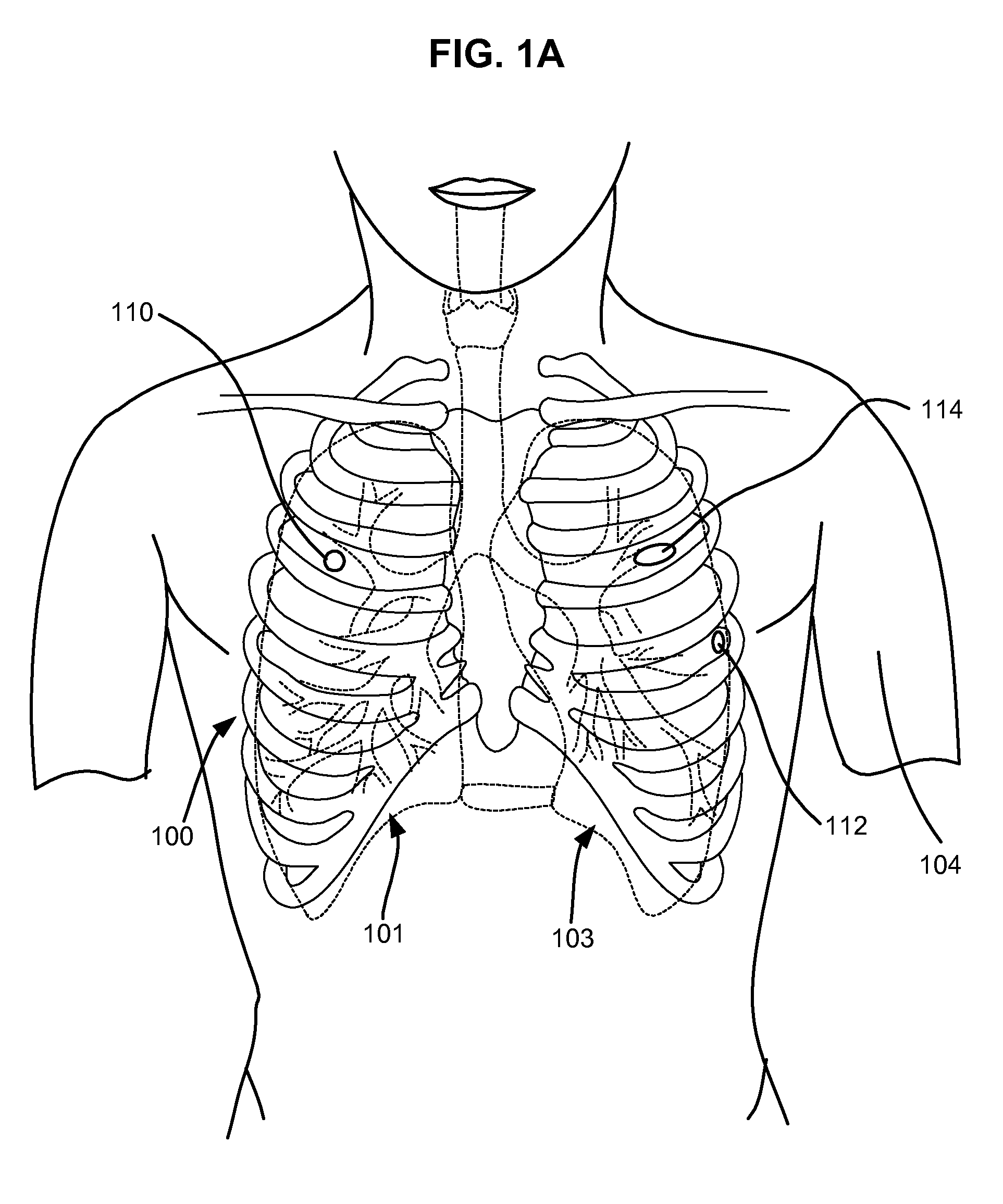 Surgical instruments for creating a pneumostoma and treating chronic obstructive pulmonary disease