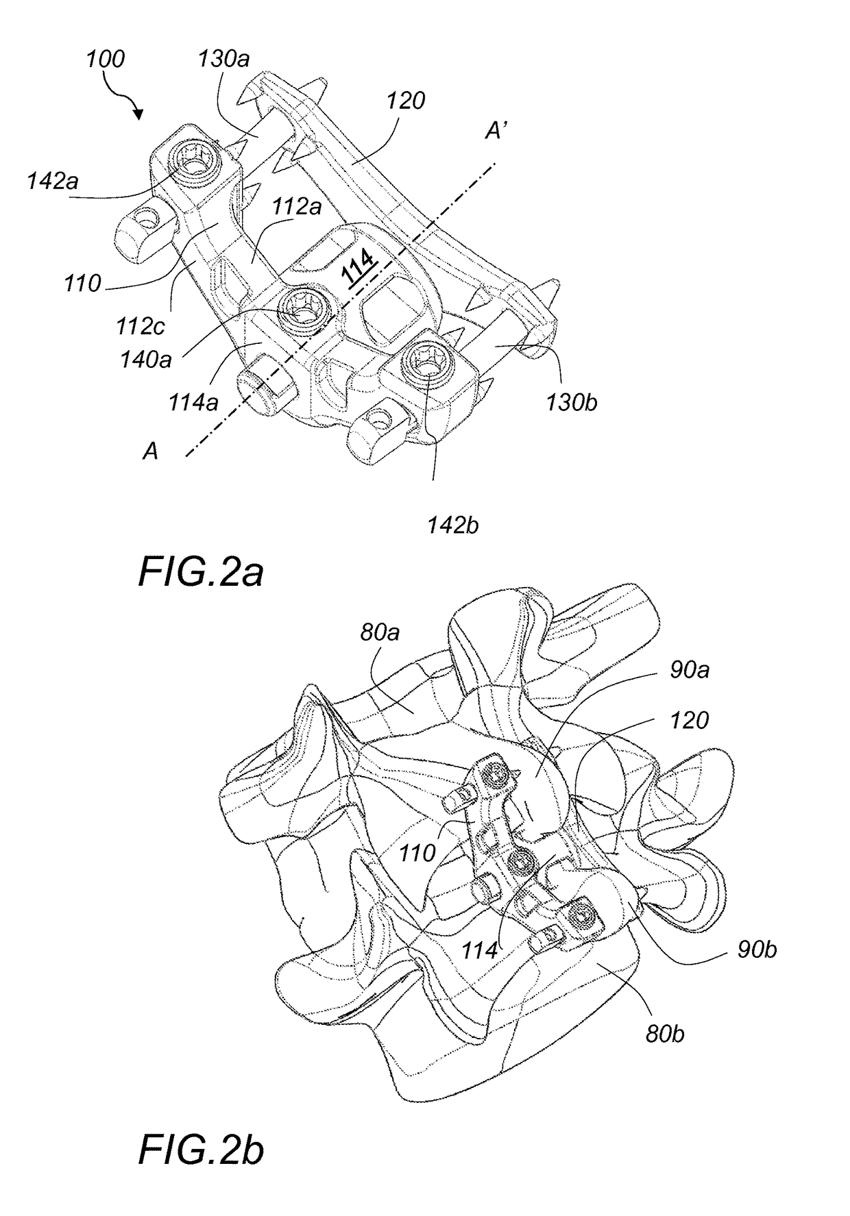 Interspinous fixation implant