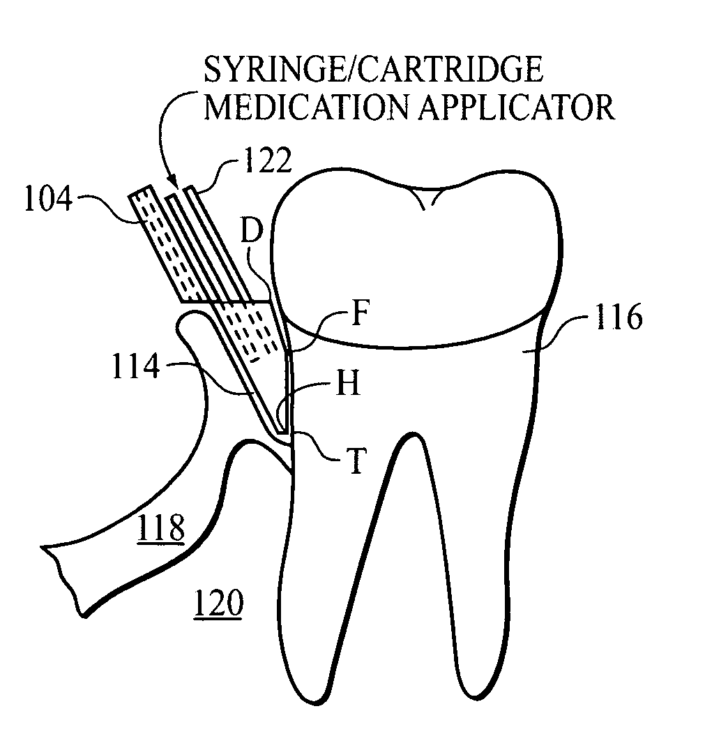 Device for local sub-gingival applications of dental medications