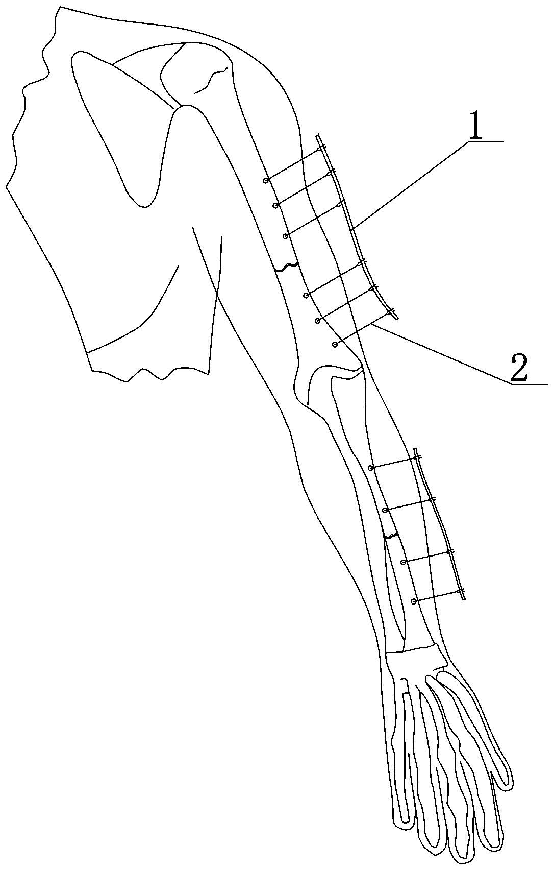 Fracture external fixing rack installation assembly