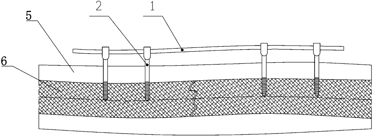 Fracture external fixing rack installation assembly