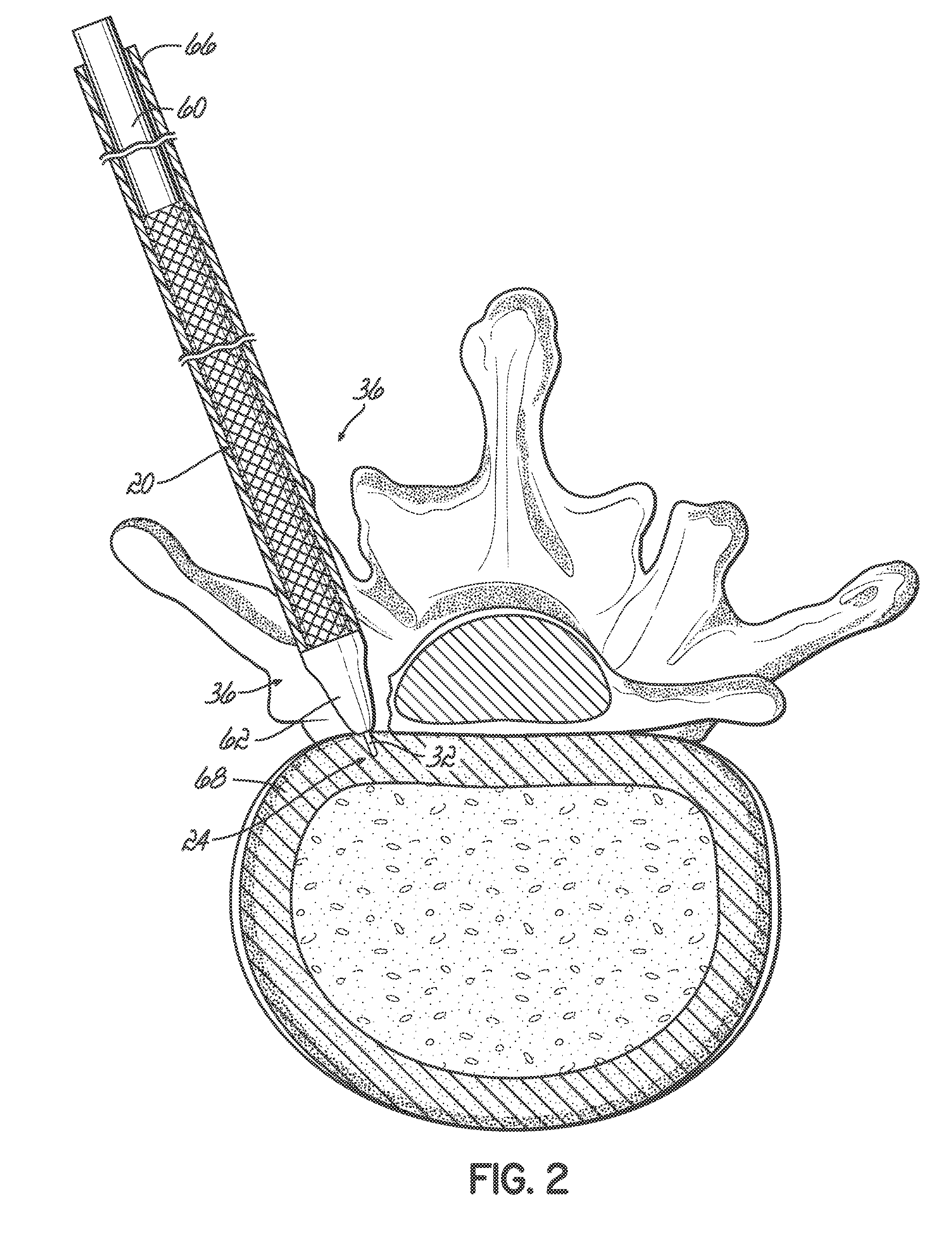 Surgical site access system and deployment device for same