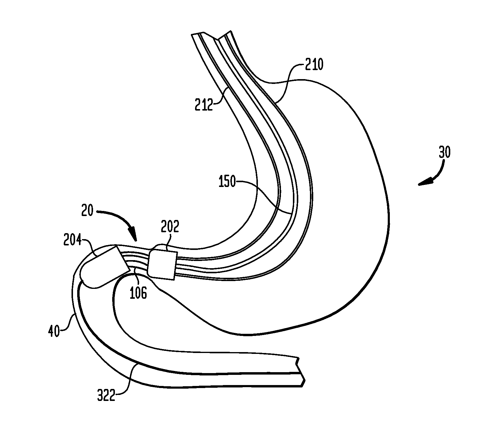 Systems and Methods for Treating Obesity and Type 2 Diabetes