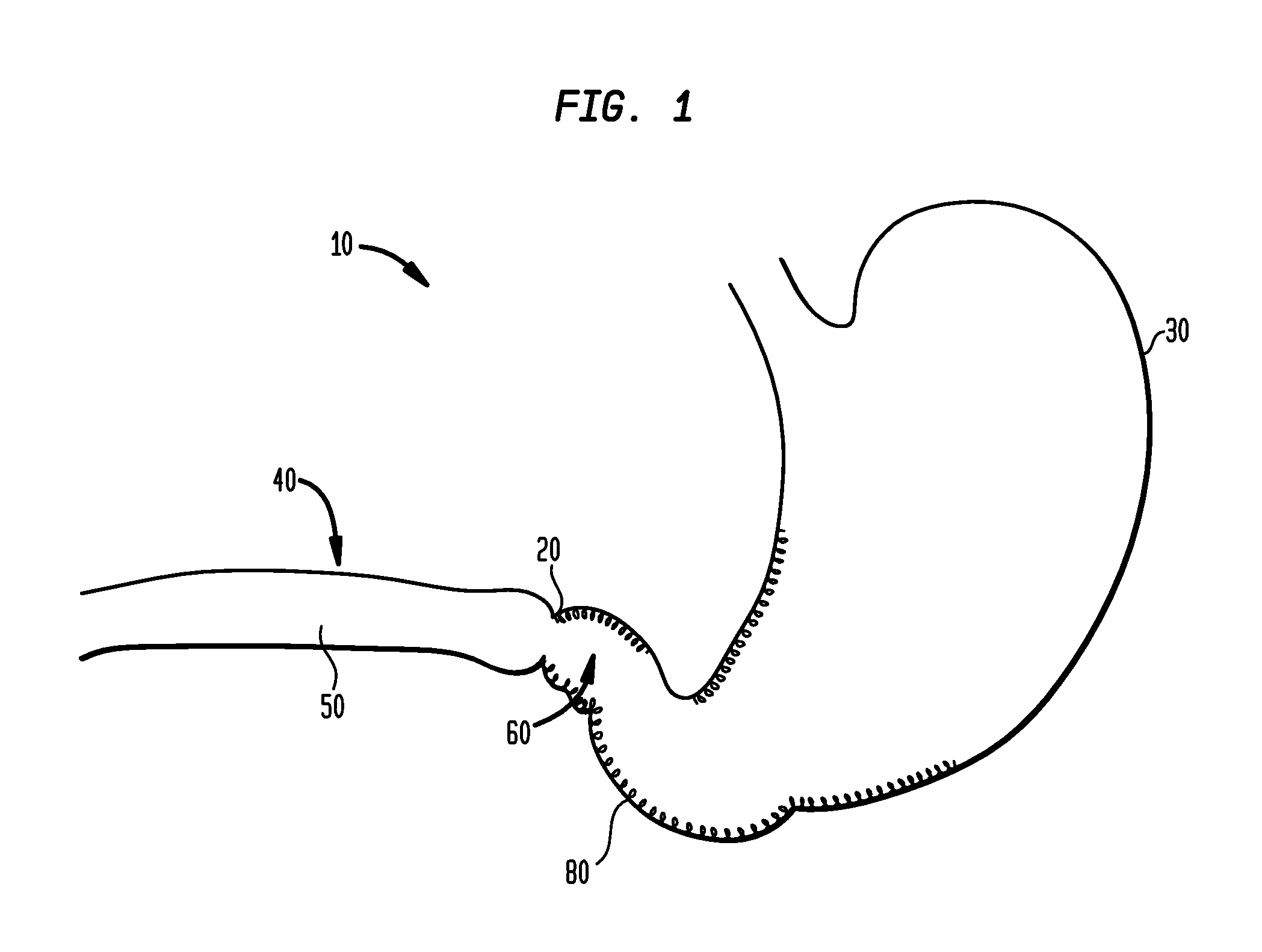 Systems and Methods for Treating Obesity and Type 2 Diabetes