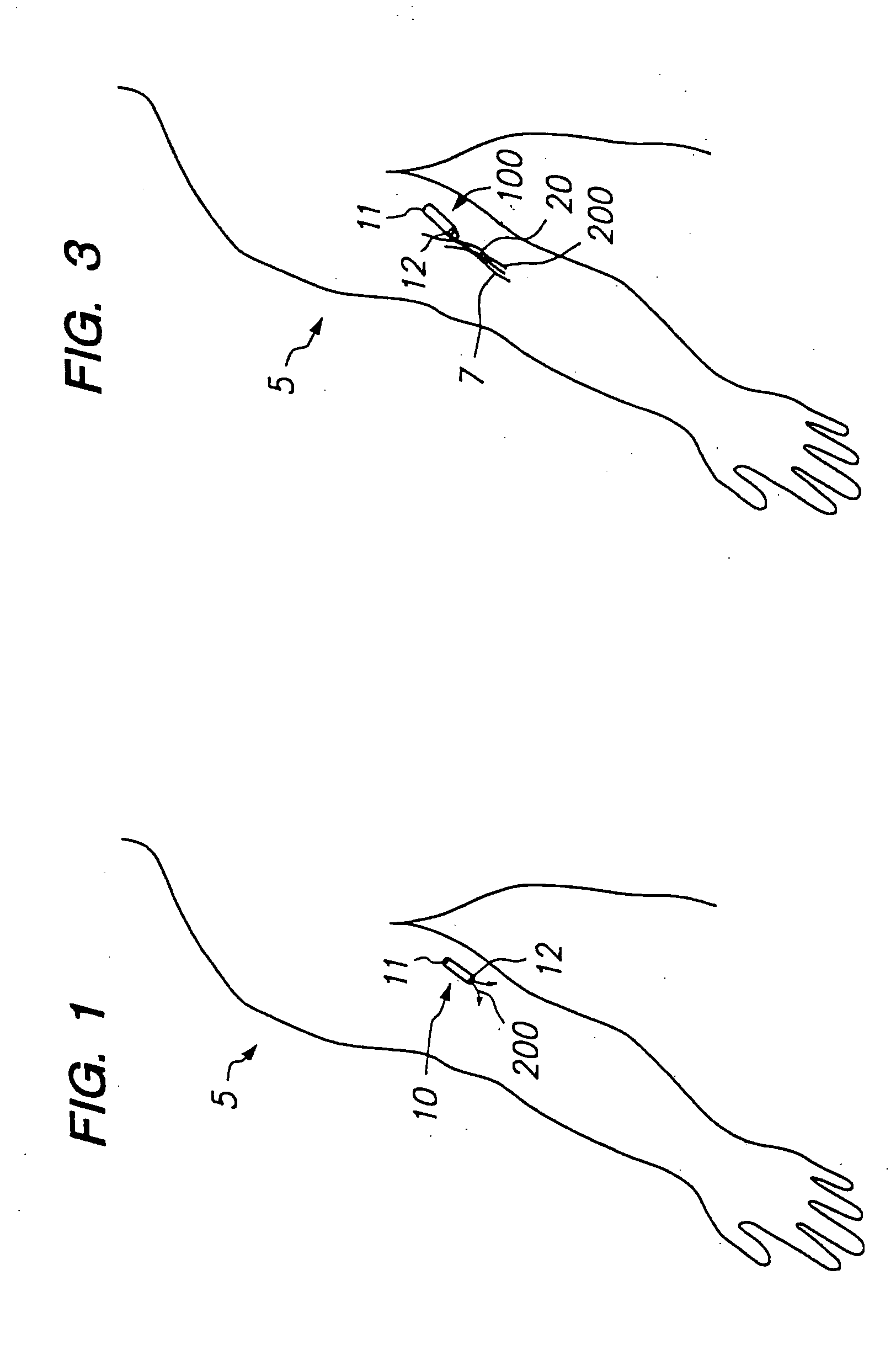 Devices and methods for pain management