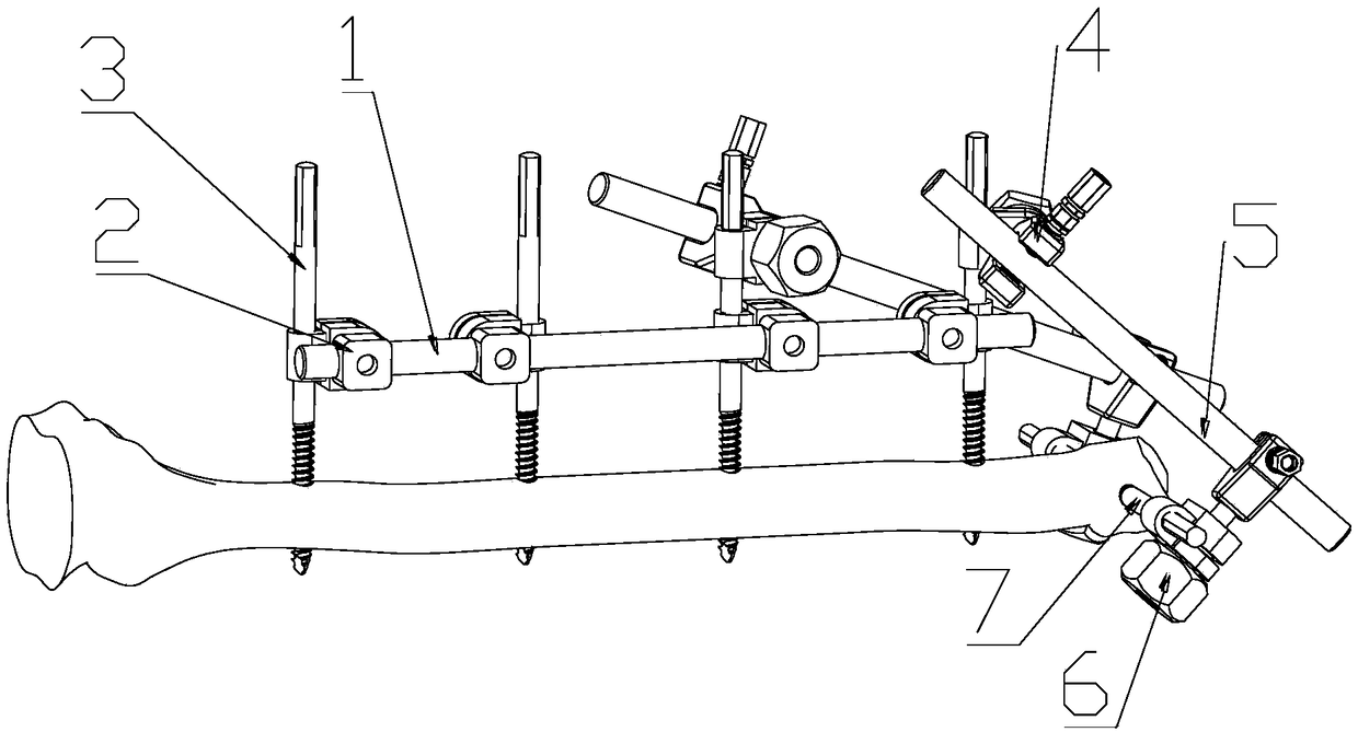 Installation device for transverse external fixation needles for hand bones