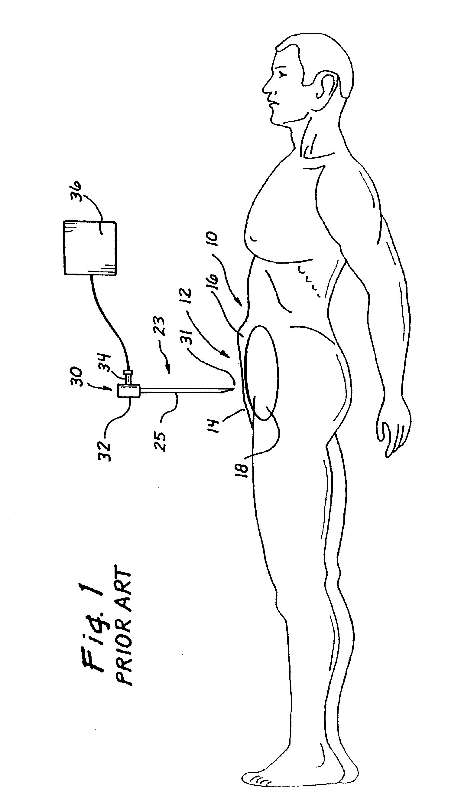 Surgical access apparatus and method