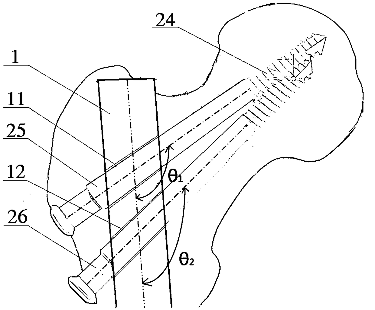 Proximal femoral cross-locking type intramedullary nail