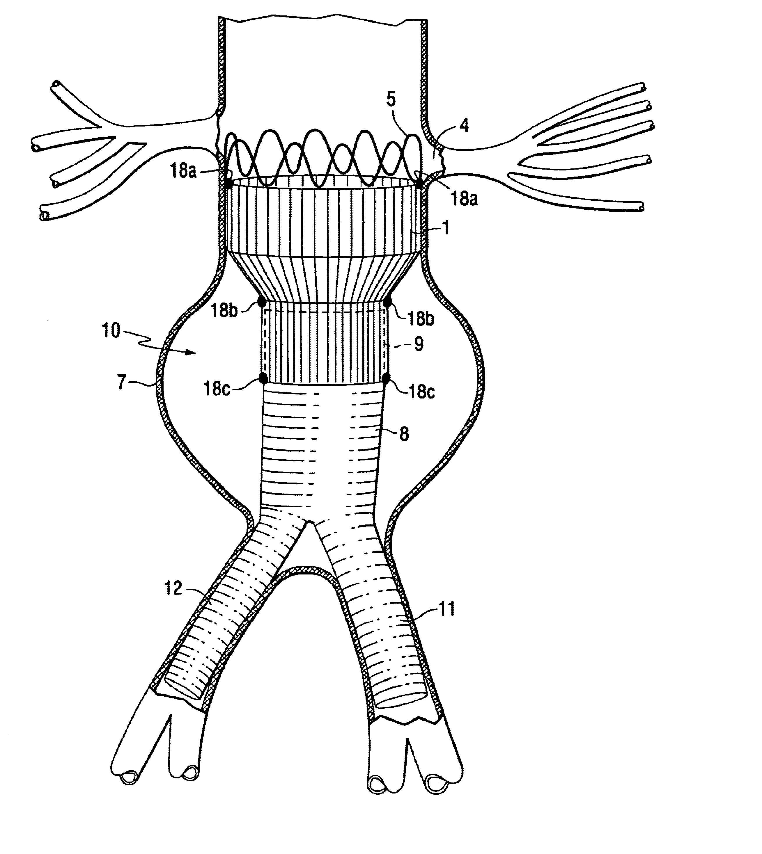 Tapered endovascular stent graft and method of treating abdominal aortic aneurysms and distal iliac aneurysms