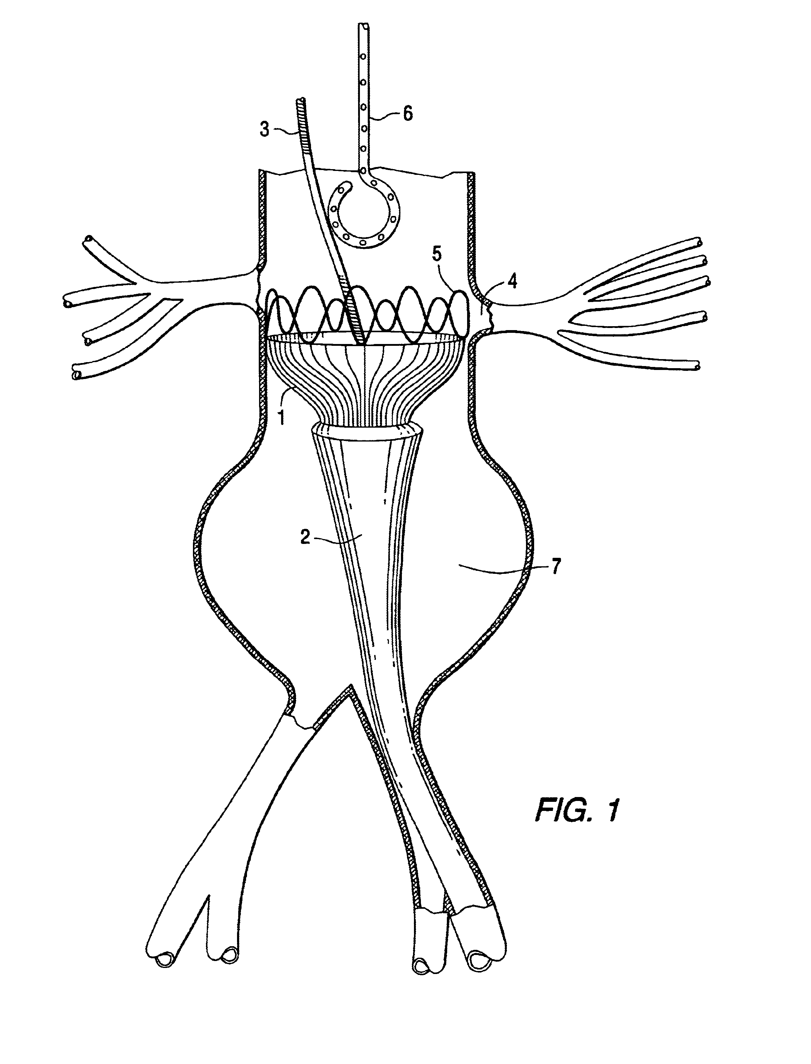 Tapered endovascular stent graft and method of treating abdominal aortic aneurysms and distal iliac aneurysms