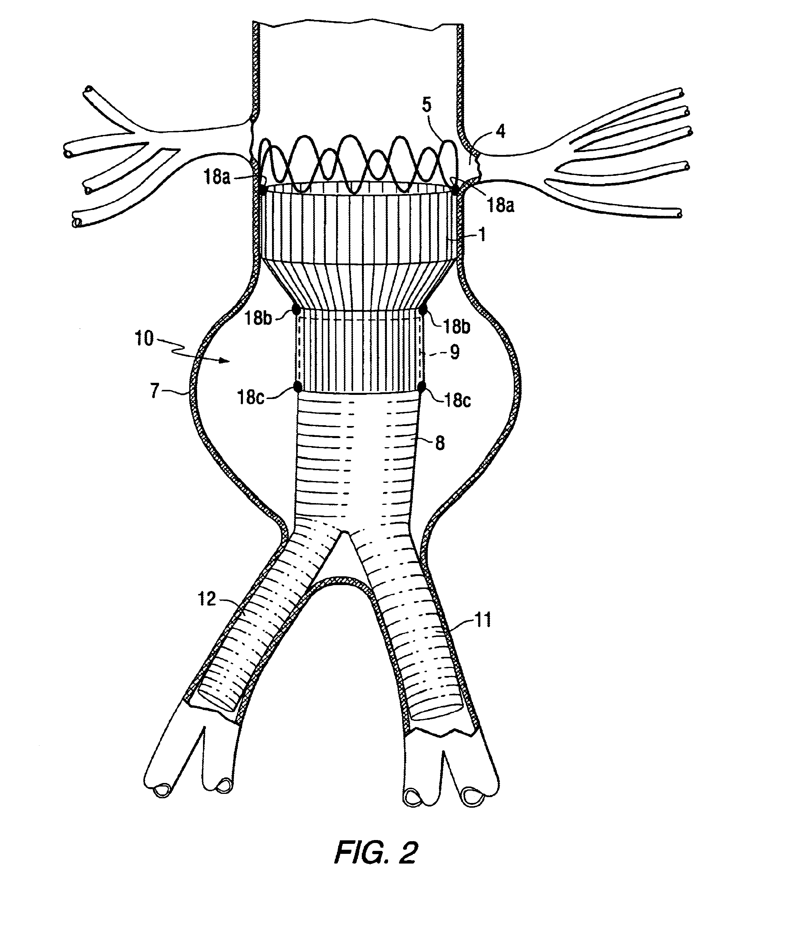 Tapered endovascular stent graft and method of treating abdominal aortic aneurysms and distal iliac aneurysms