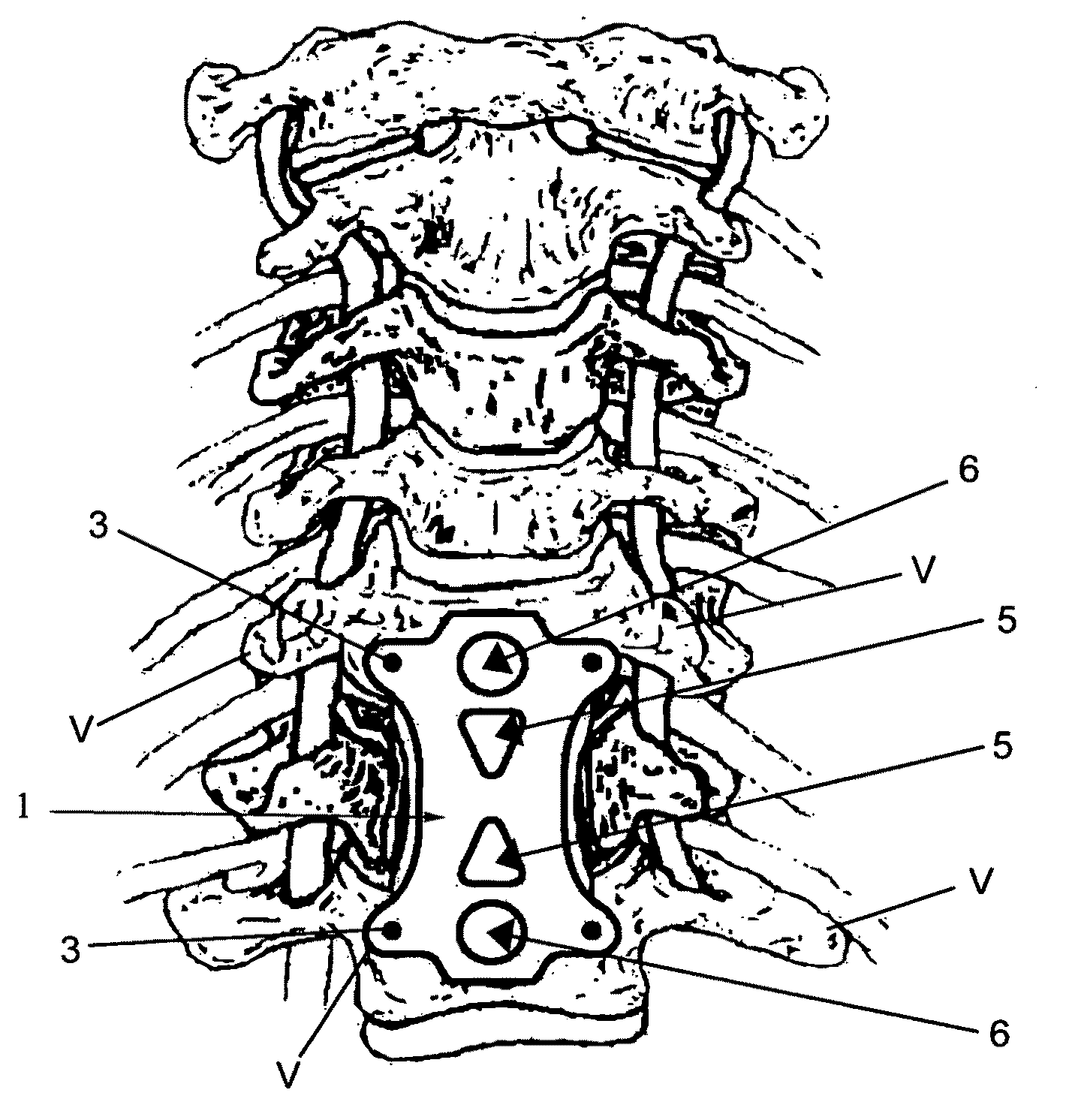 Anterior cervical staple