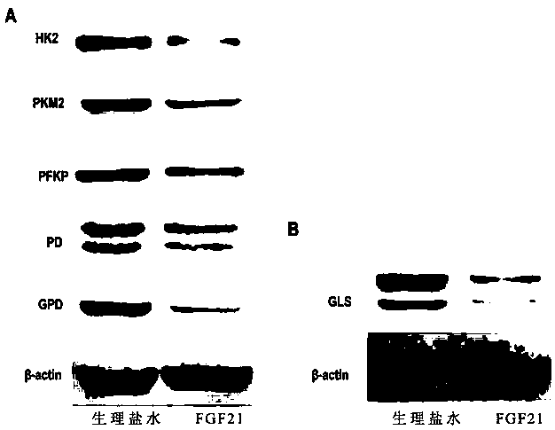 Application of FGF21 in preparation of medicine for treating colorectal cancer