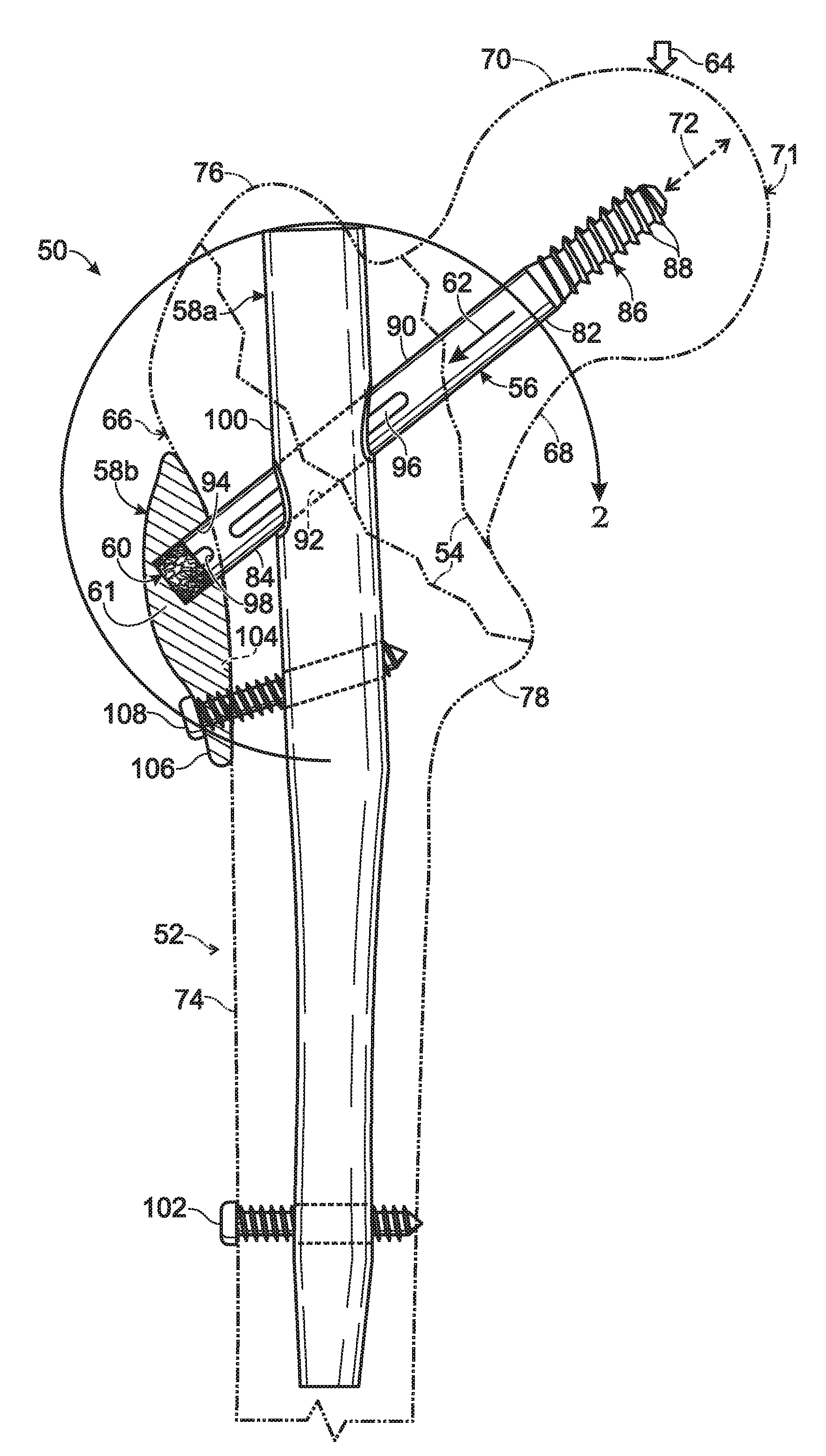 Hip fixation with load-controlled dynamization