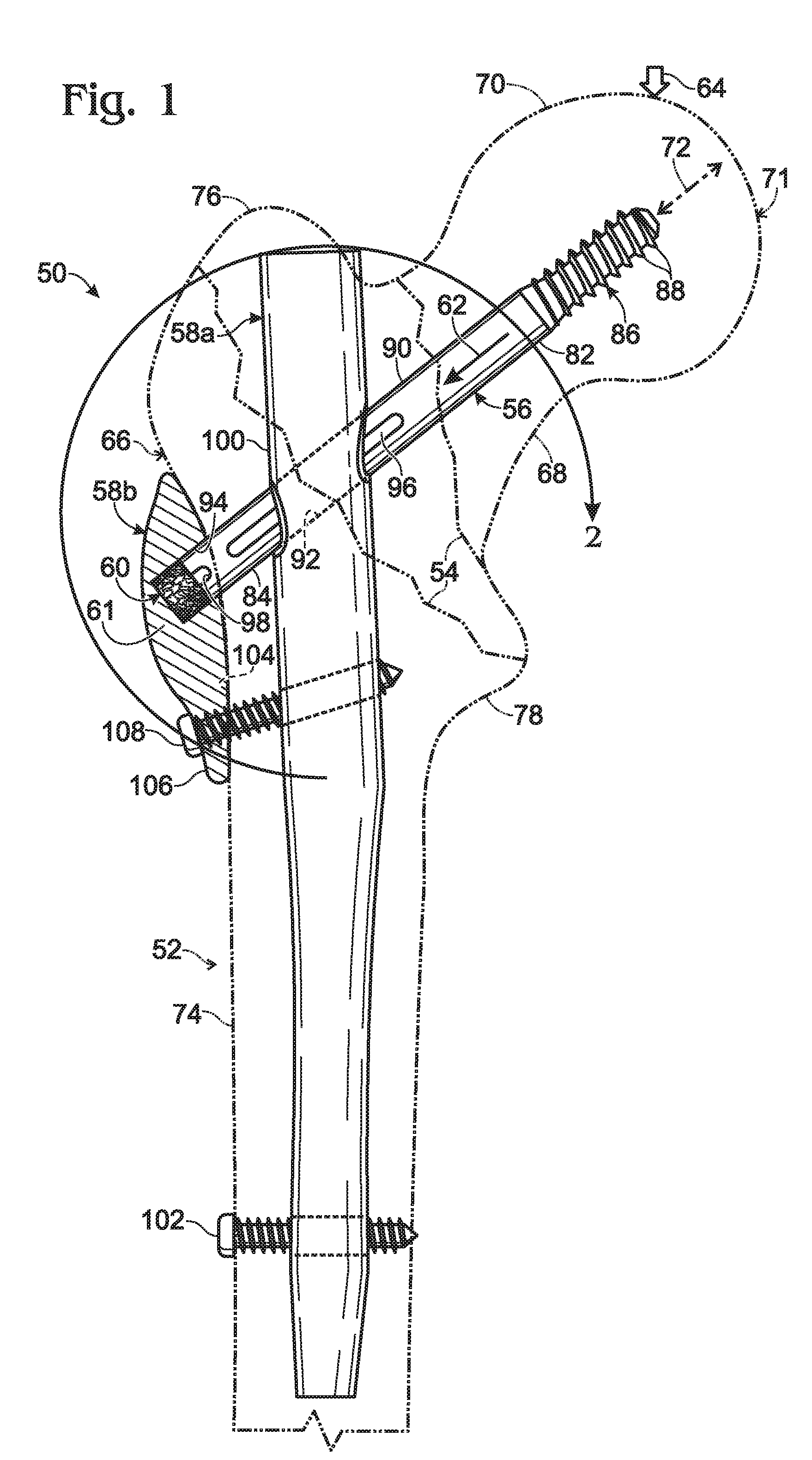 Hip fixation with load-controlled dynamization