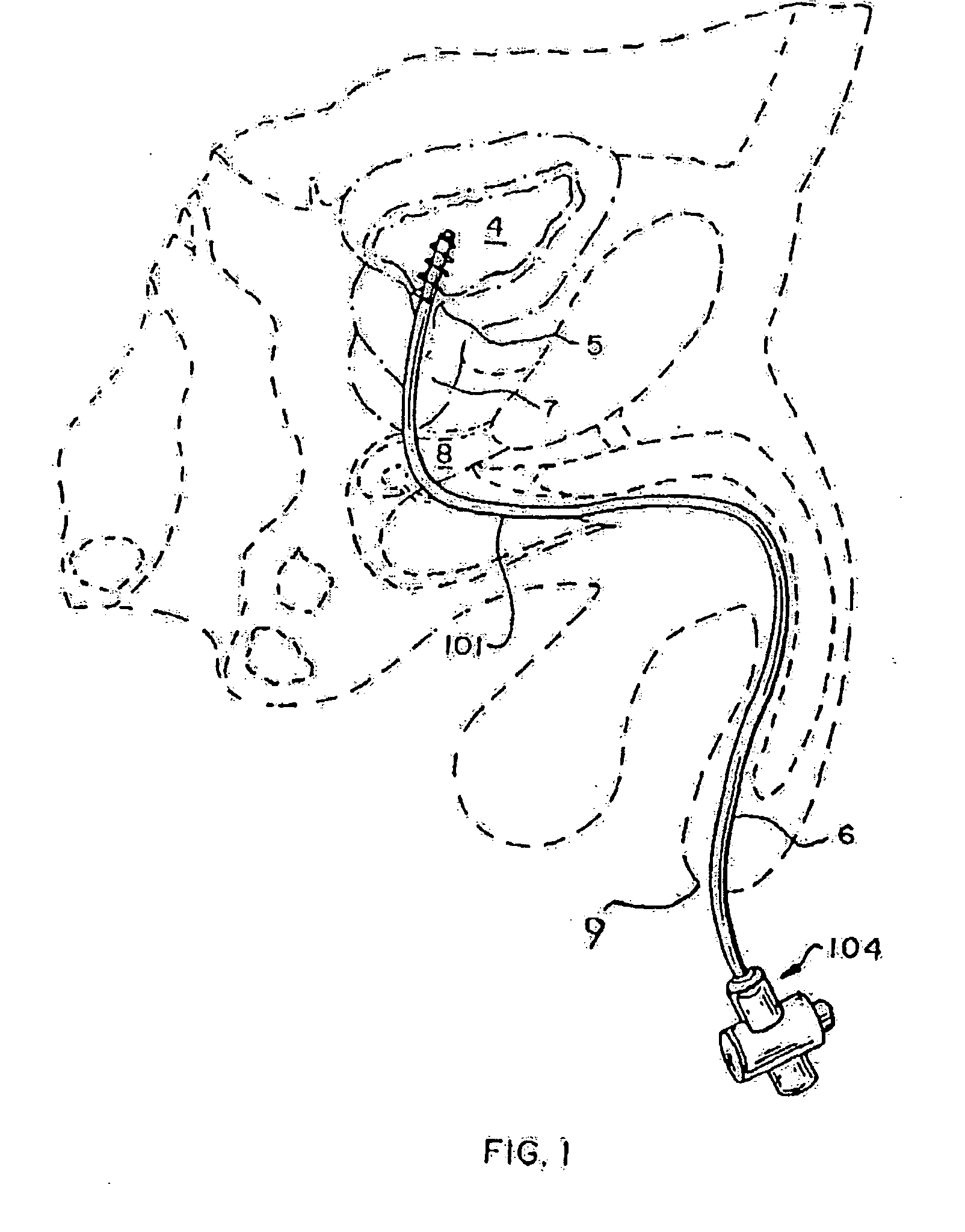 Rotate-to-advance catheterization system