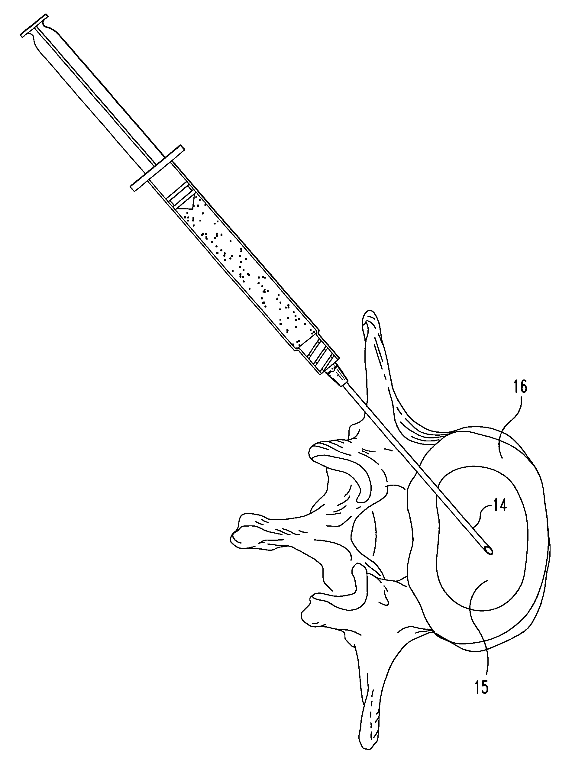 Compositions and methods for treating intervertebral discs with collagen-based materials