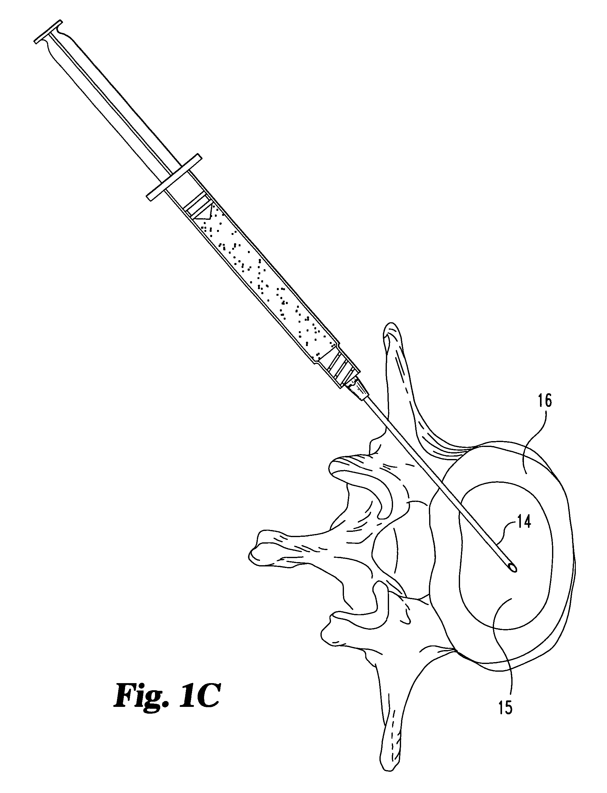 Compositions and methods for treating intervertebral discs with collagen-based materials