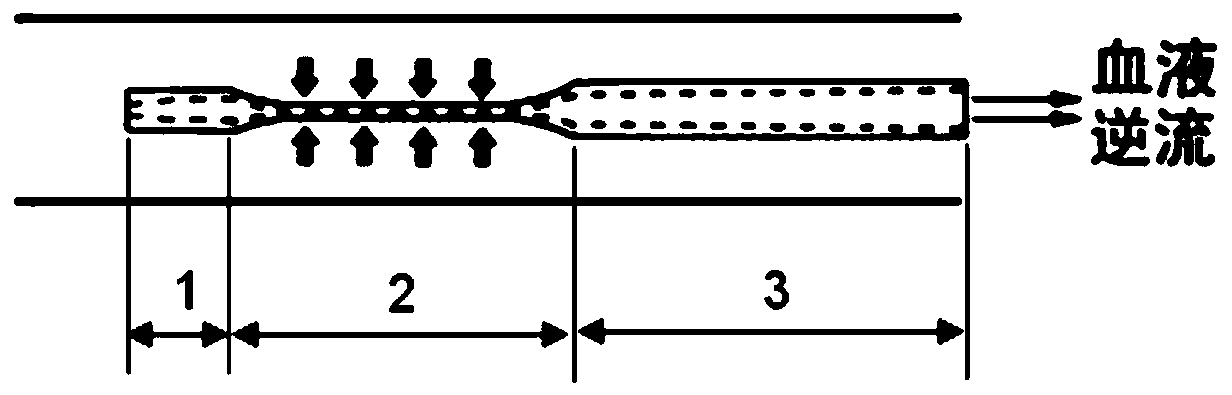 An injection catheter for vascular intervention with anti-reflux and anti-reflux accidental embolism