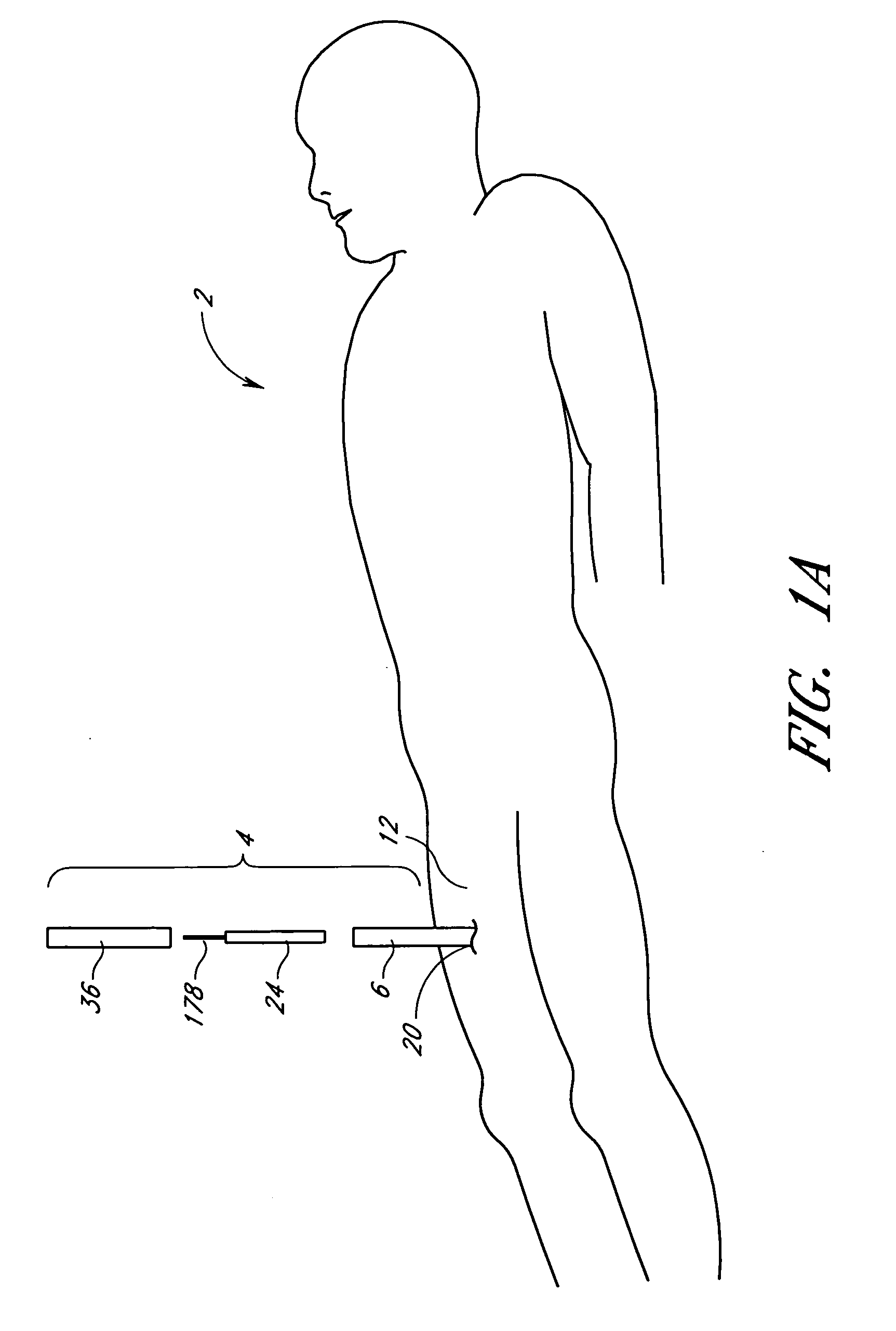 Suturing device and method