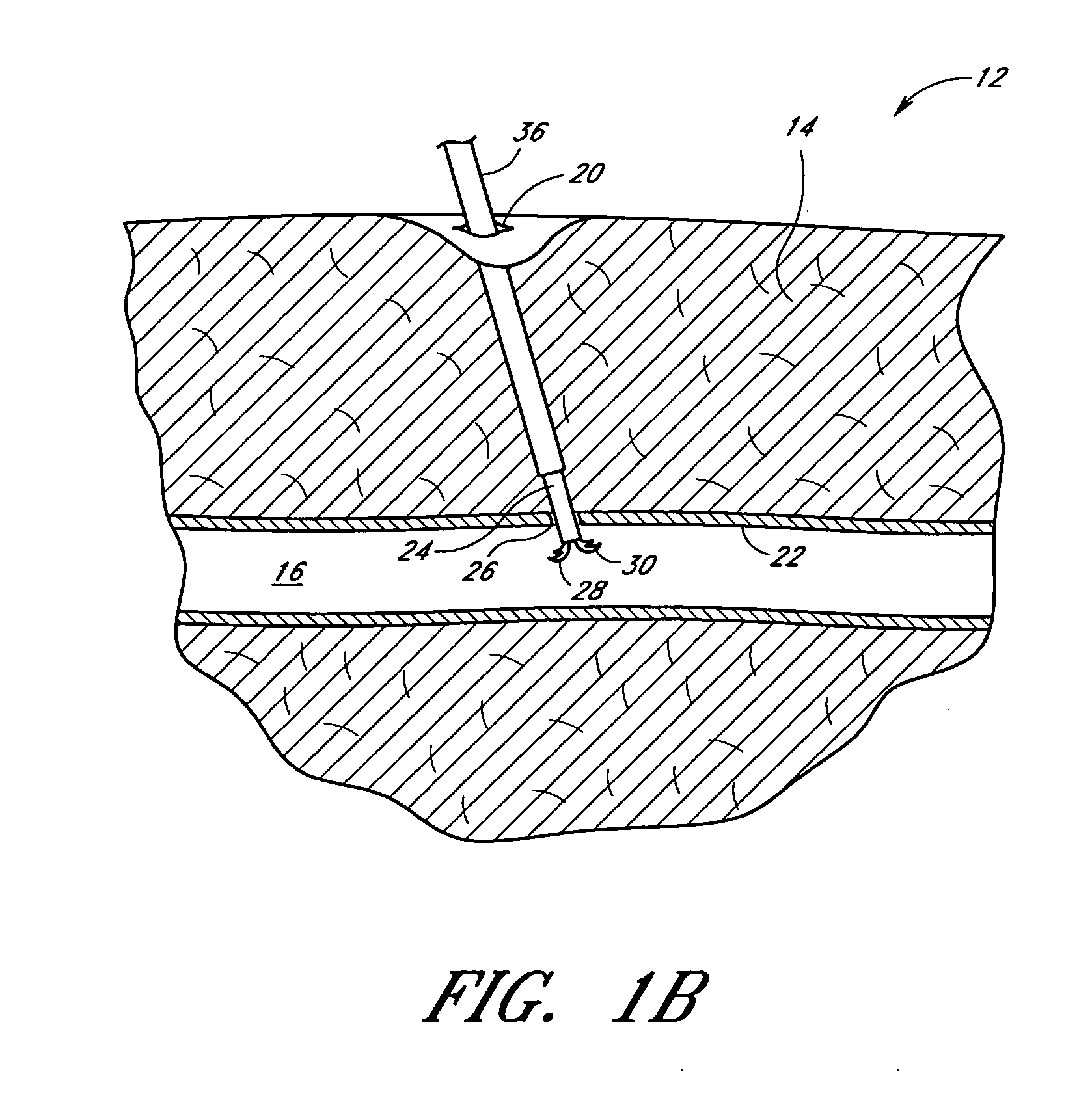 Suturing device and method