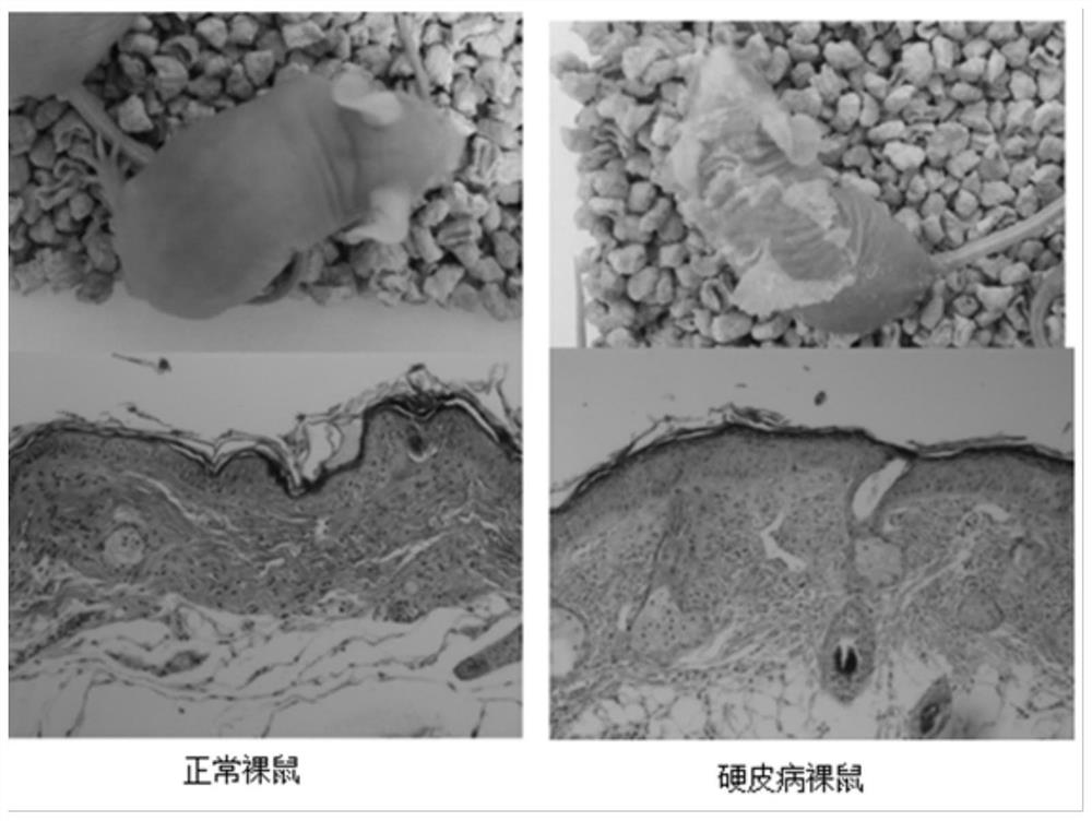 Application of adipose-derived stem cells in localized scleroderma