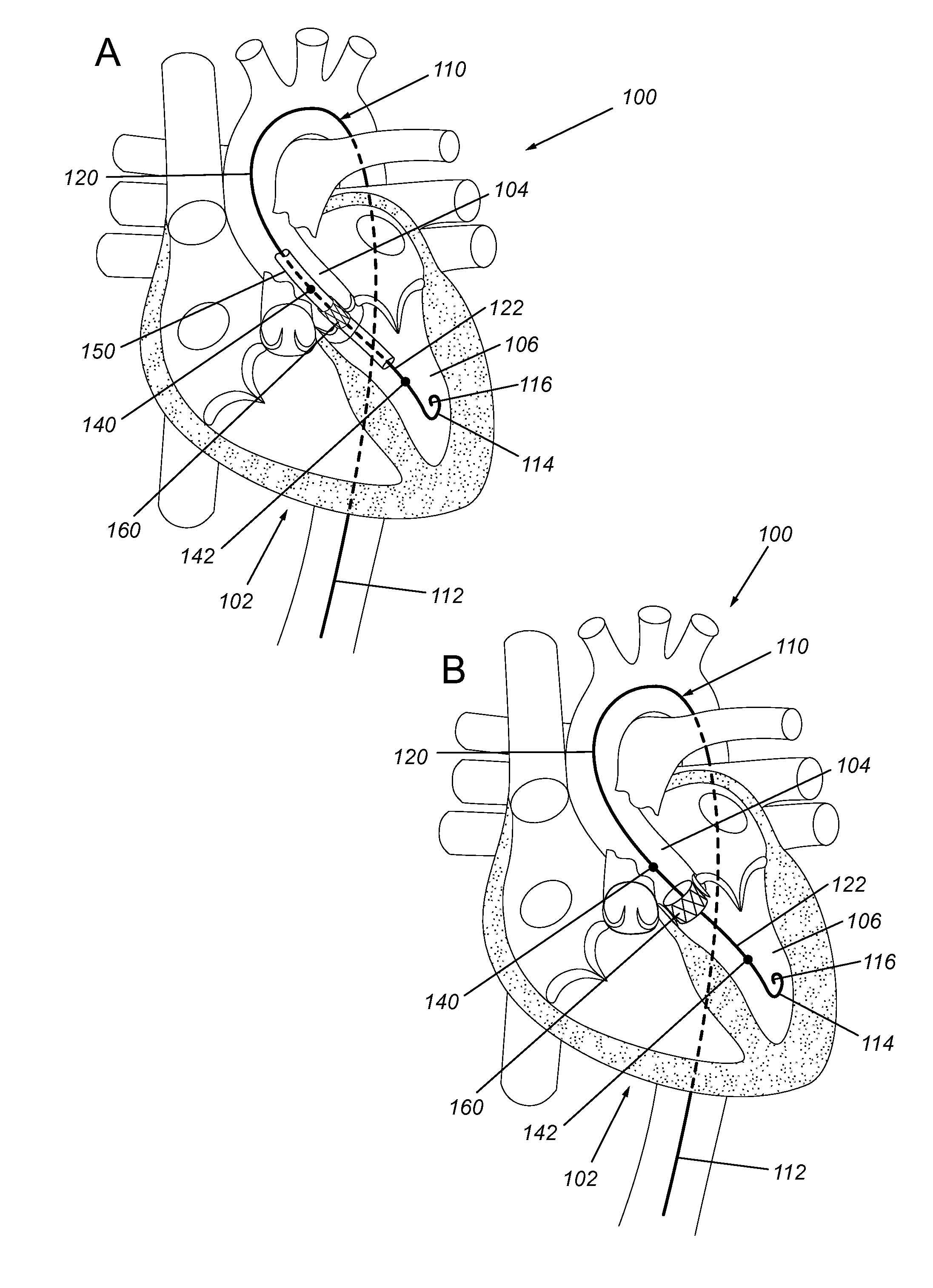 Transcatheter aortic valve implantation pressure wires and uses thereof