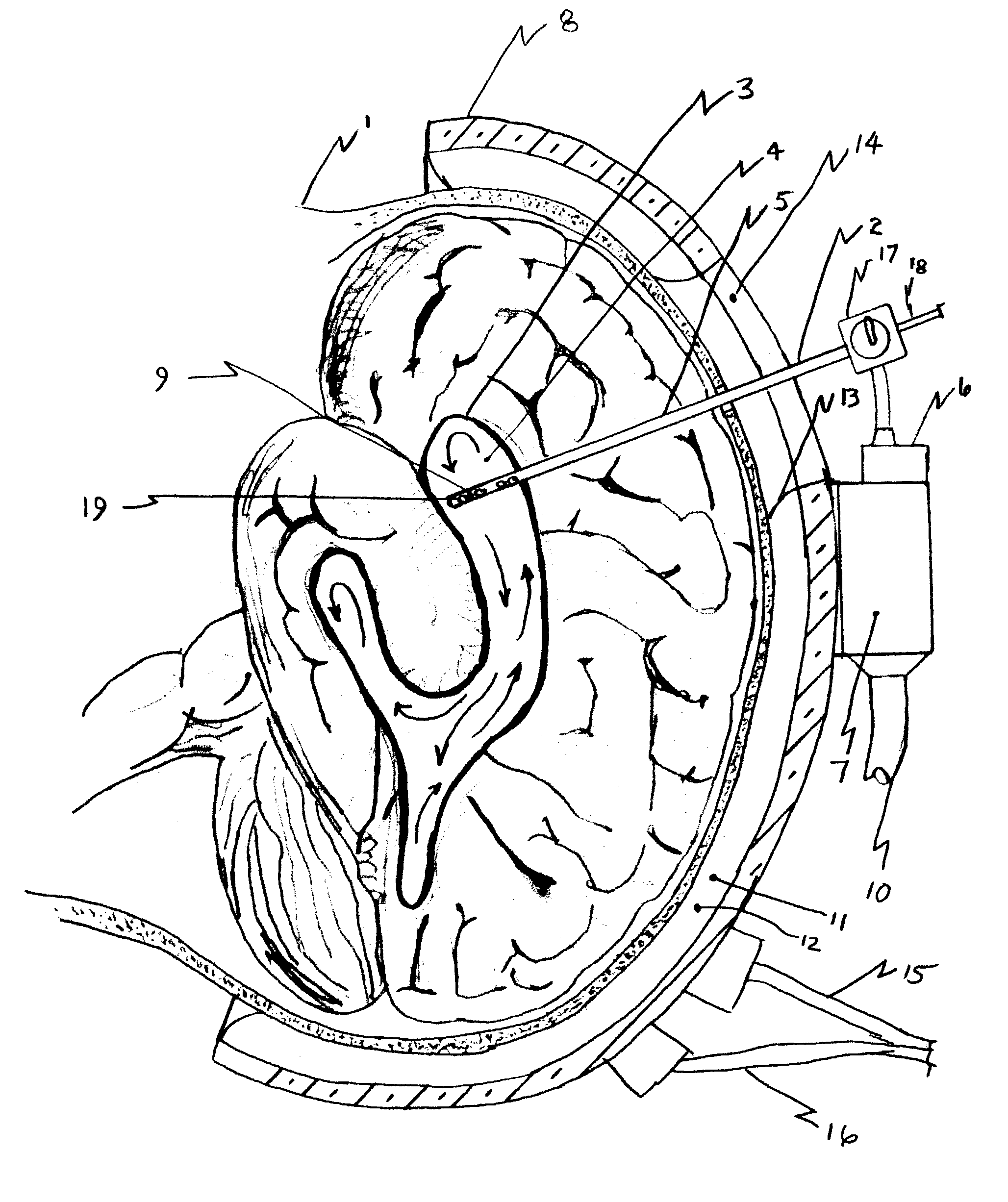 Uniform selective cerebral hypothermia