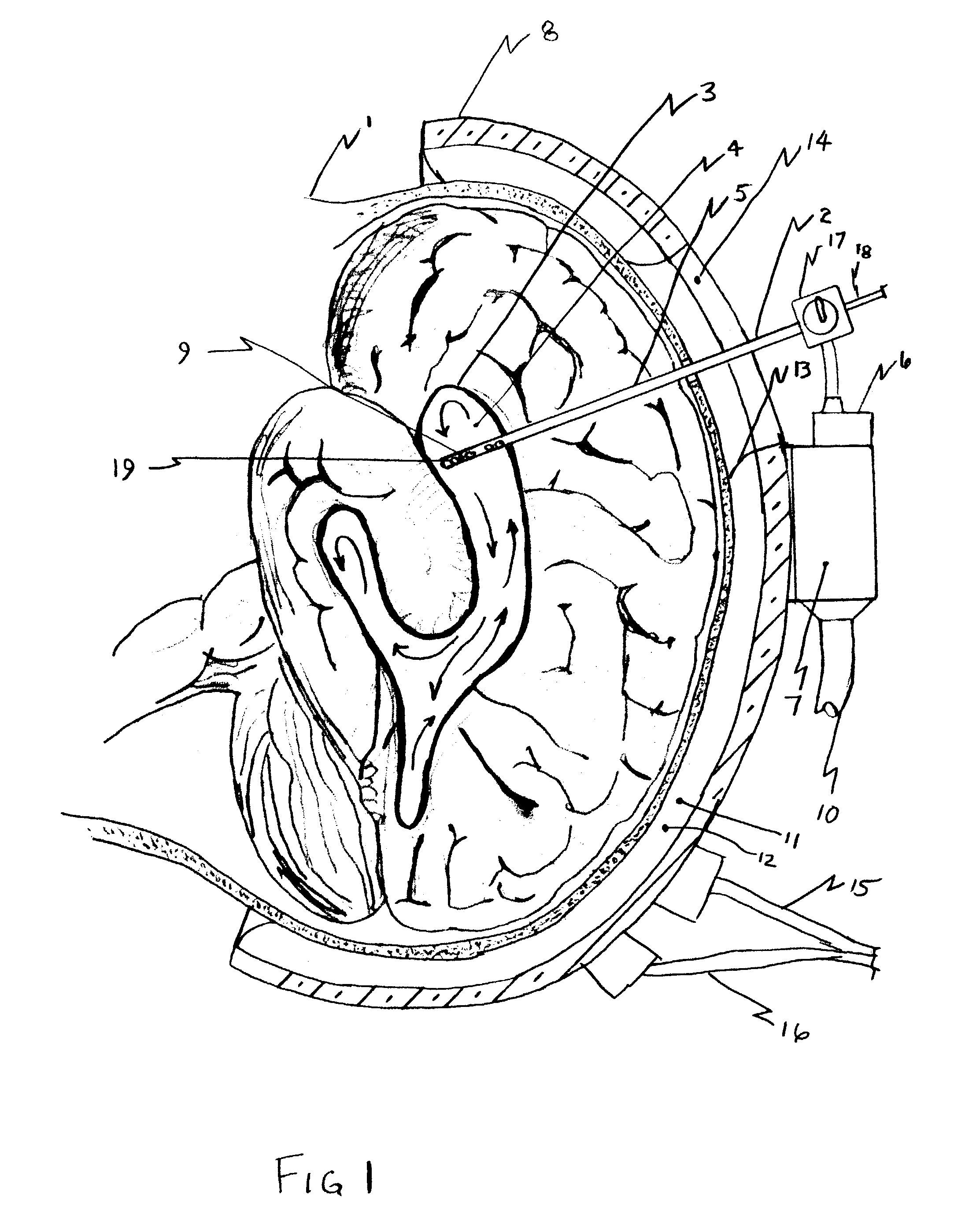 Uniform selective cerebral hypothermia