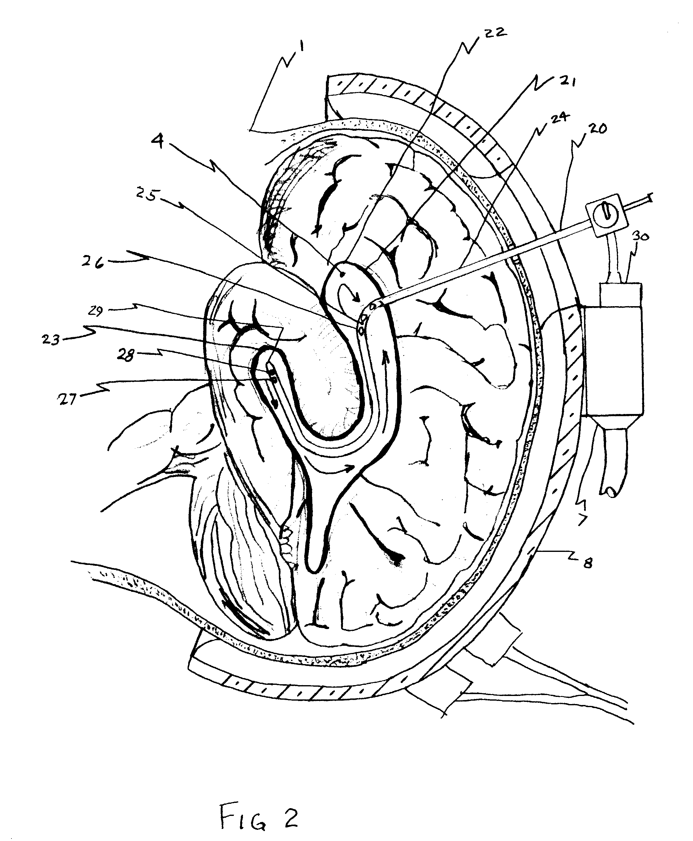 Uniform selective cerebral hypothermia