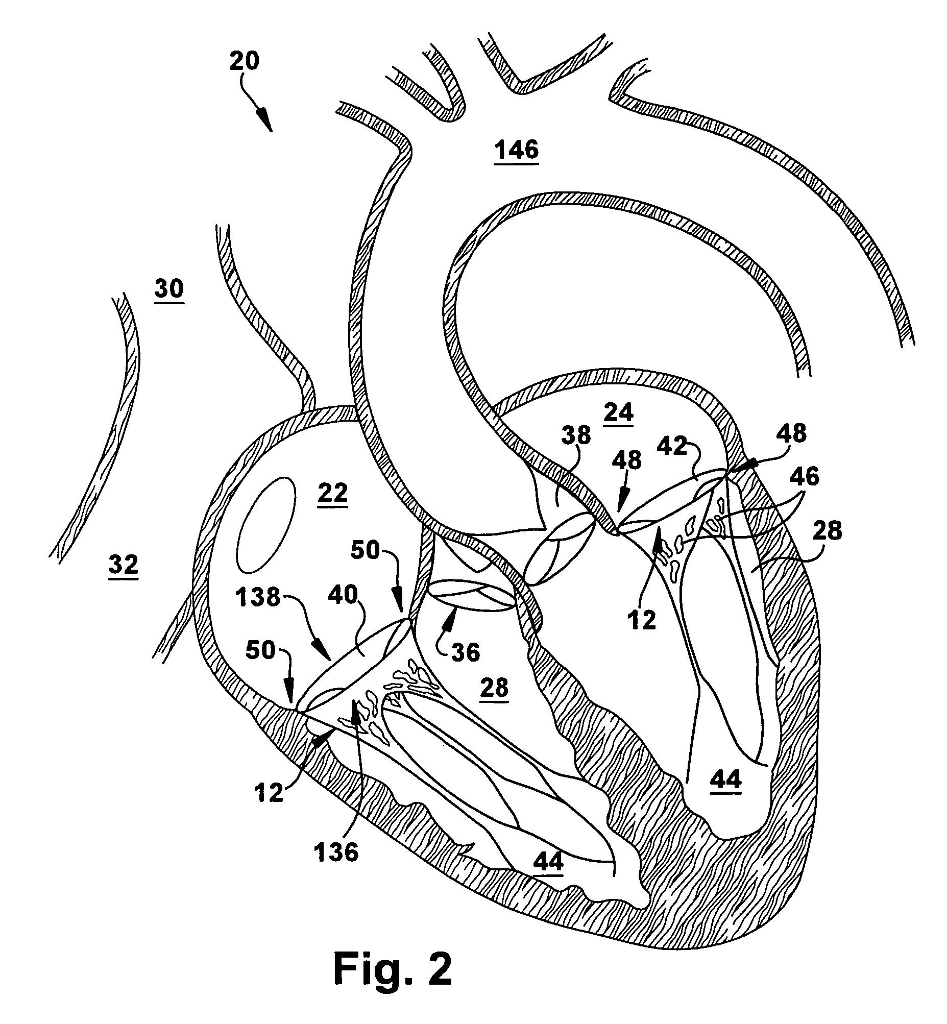 Apparatus and method for reducing cardiac valve regurgitation