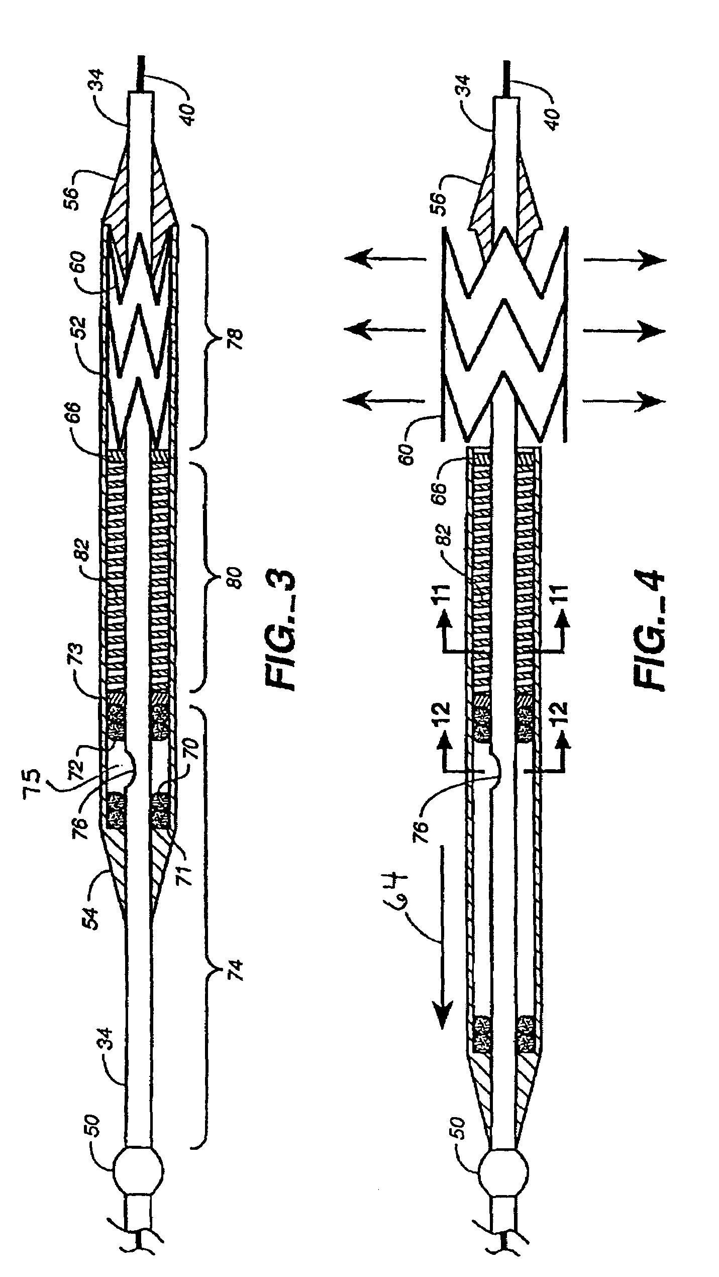 Stent delivery system with hydraulic deployment