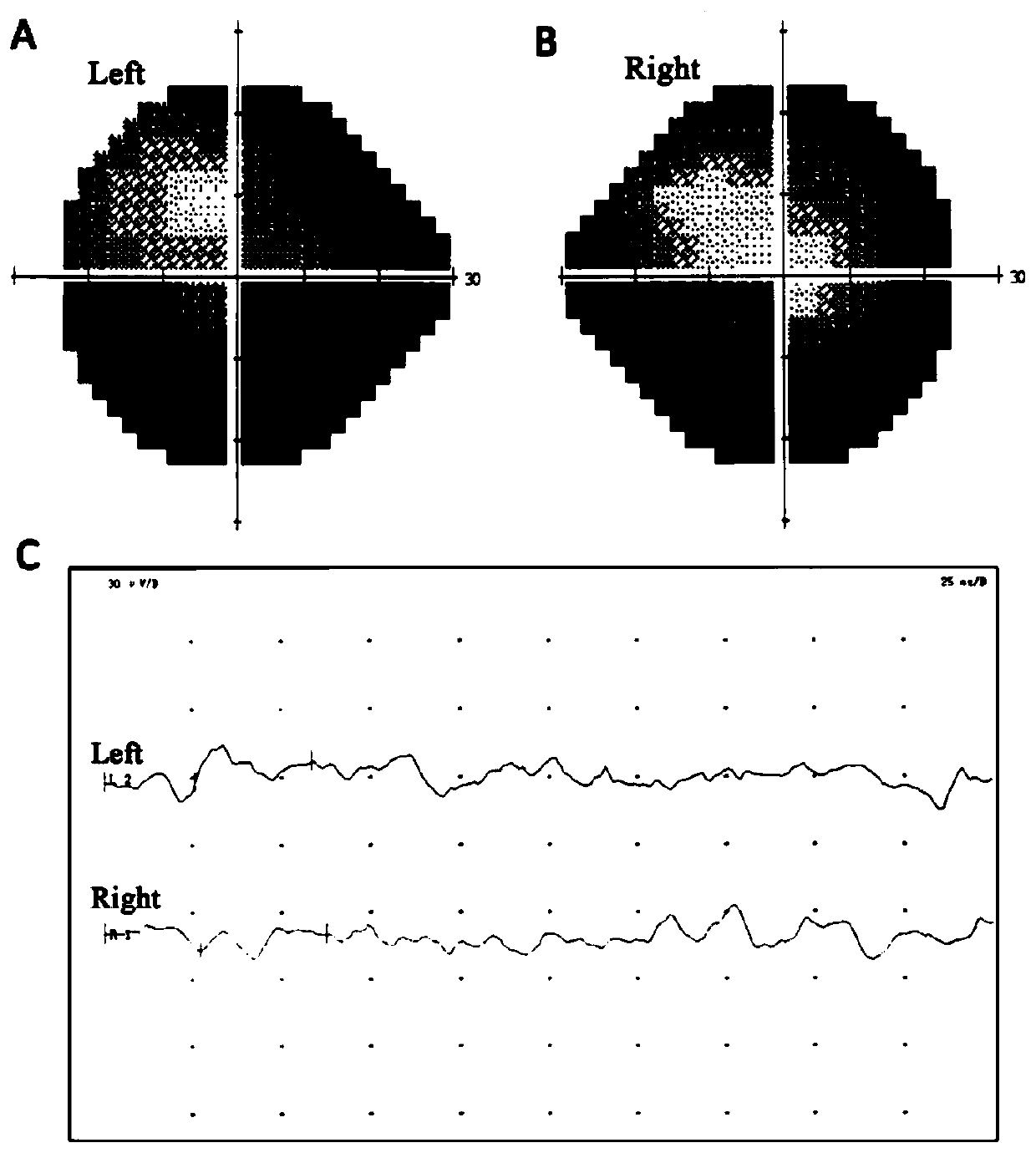 Application of ZNF124 gene in early screening or auxiliary diagnosis of retinal pigment degeneration disease