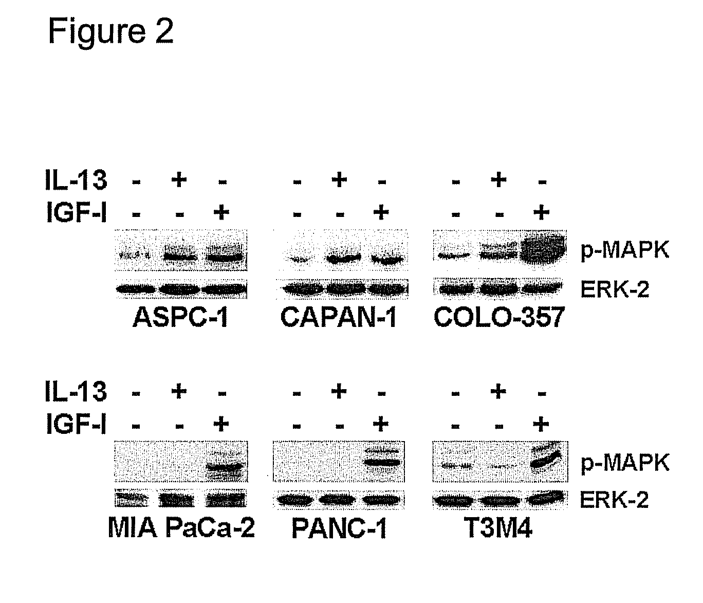 Il-4 receptor and il-13 as prognostic markers for colon and pancreas tumors