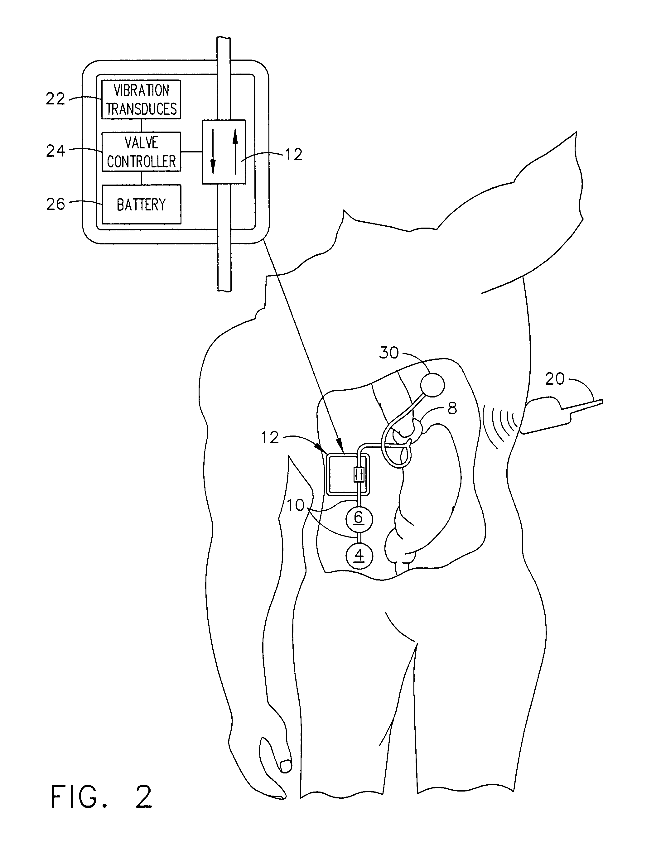 Implantable adjustable sphincter system