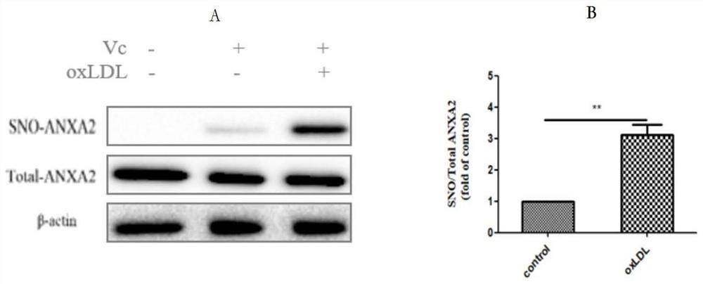 Medicinal application of interfering with annexin a2 sulfhydryl nitrosylation modification