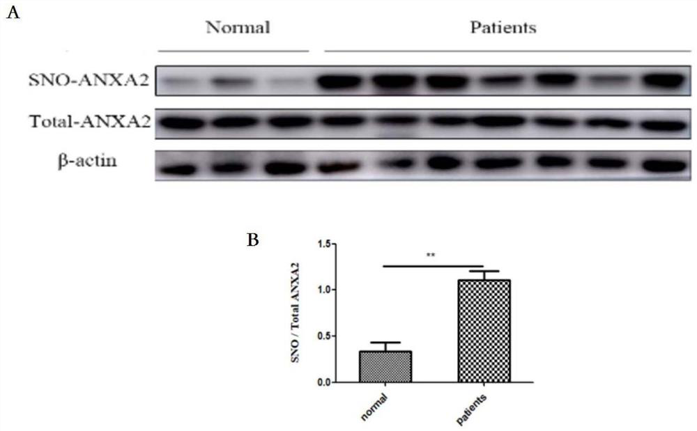 Medicinal application of interfering with annexin a2 sulfhydryl nitrosylation modification